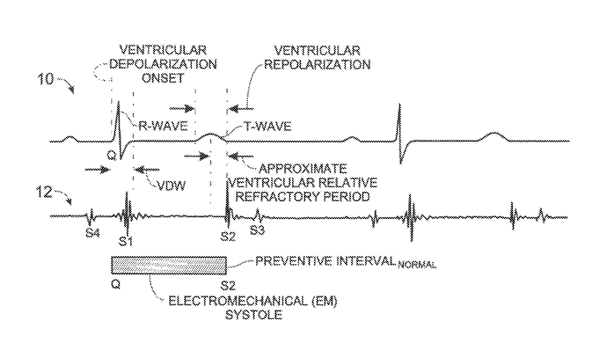 CRM-device ventricular-pacing blanking control