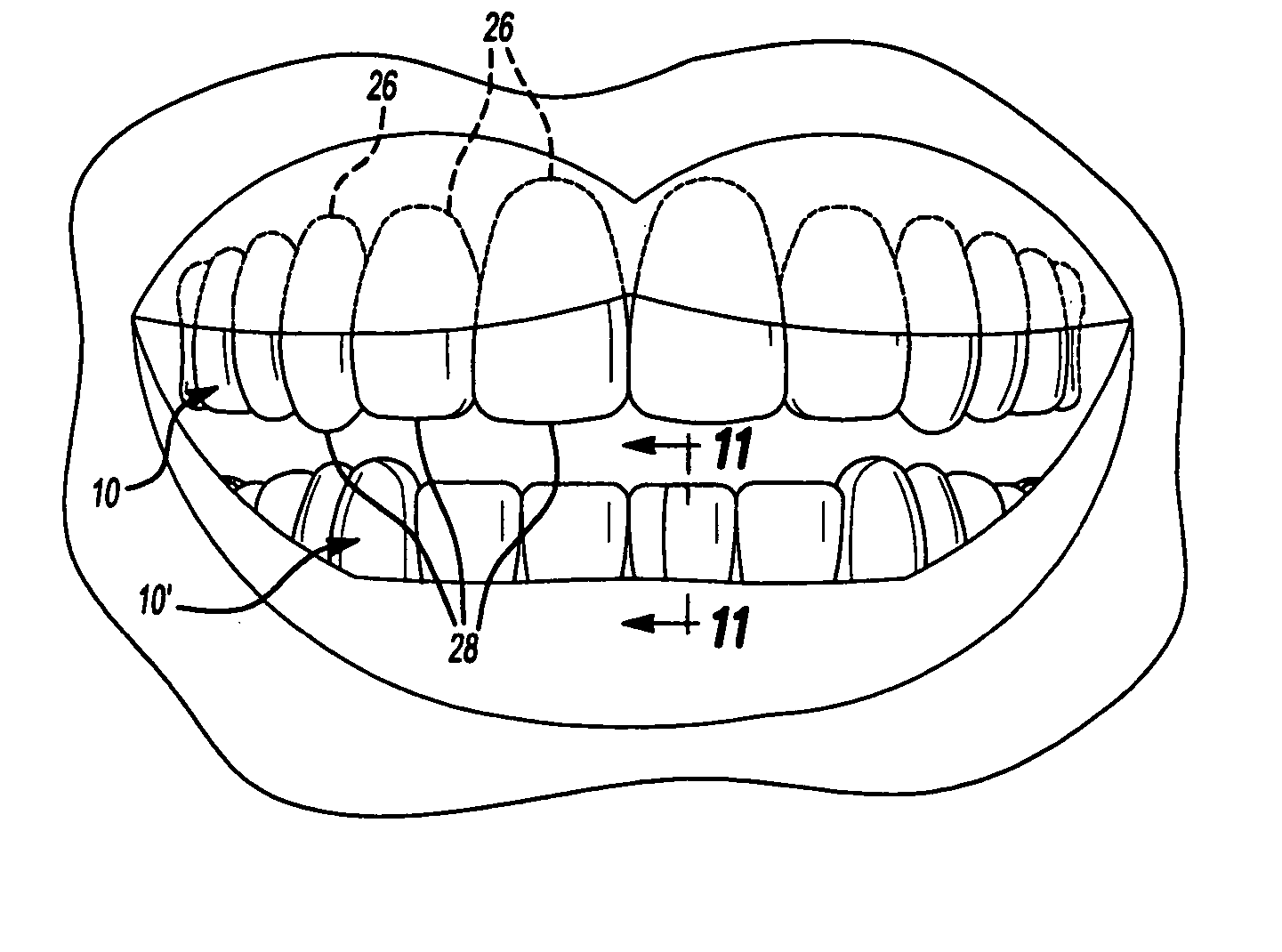 Dental template and method of visually demonstrating an overlay for a dental patient and setting the horizontal plane with an overlay