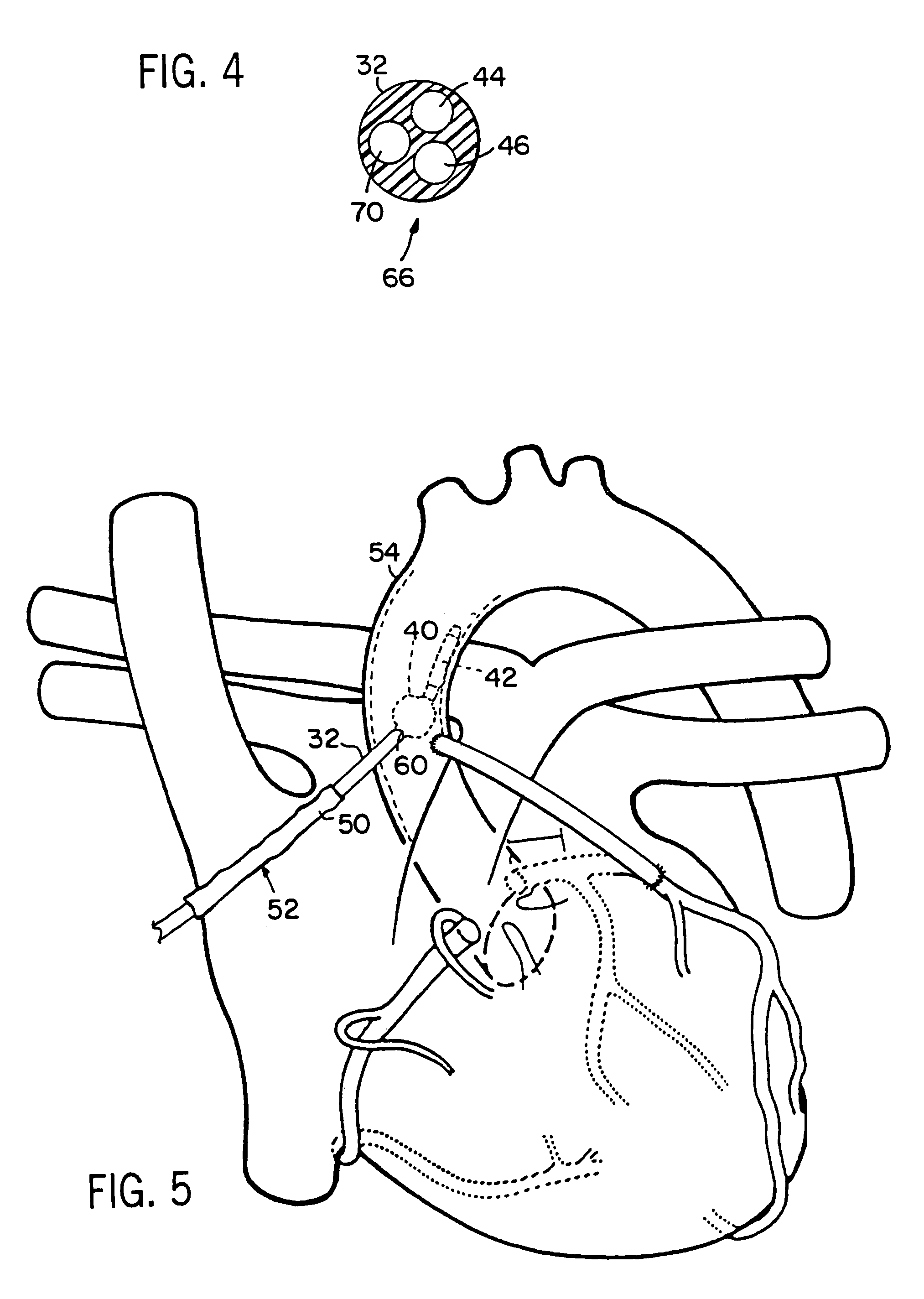 Intravascular balloon occlusion device and method for using the same