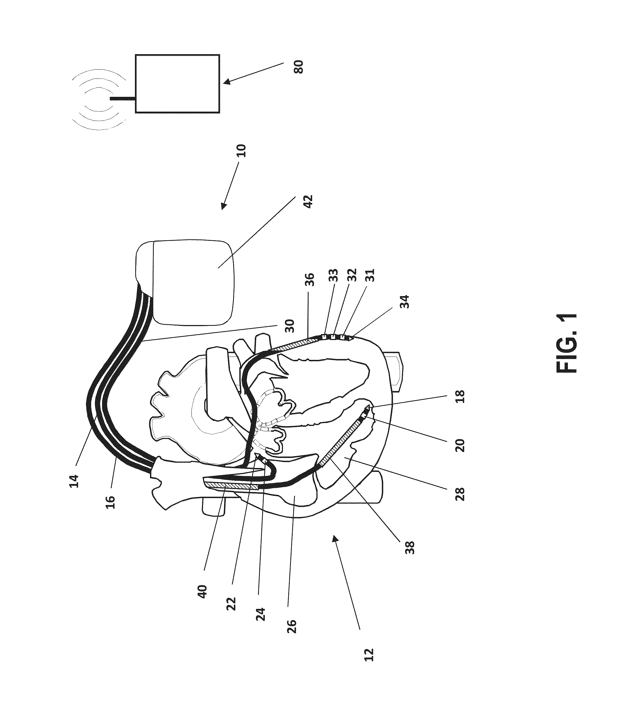 Apparatus and method to optimize pacing parameters