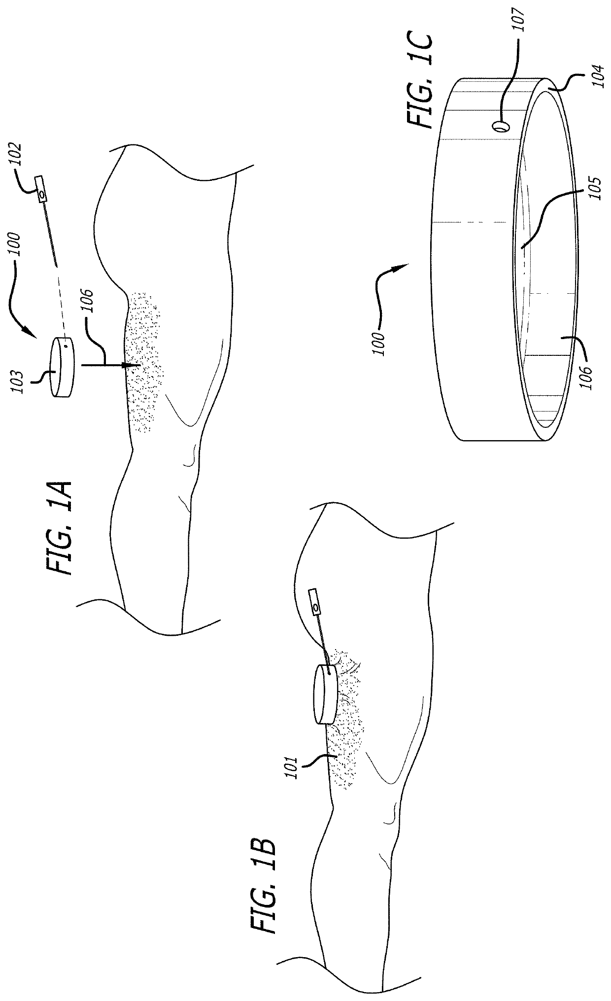 Devices and methods for performing subcutaneous surgery