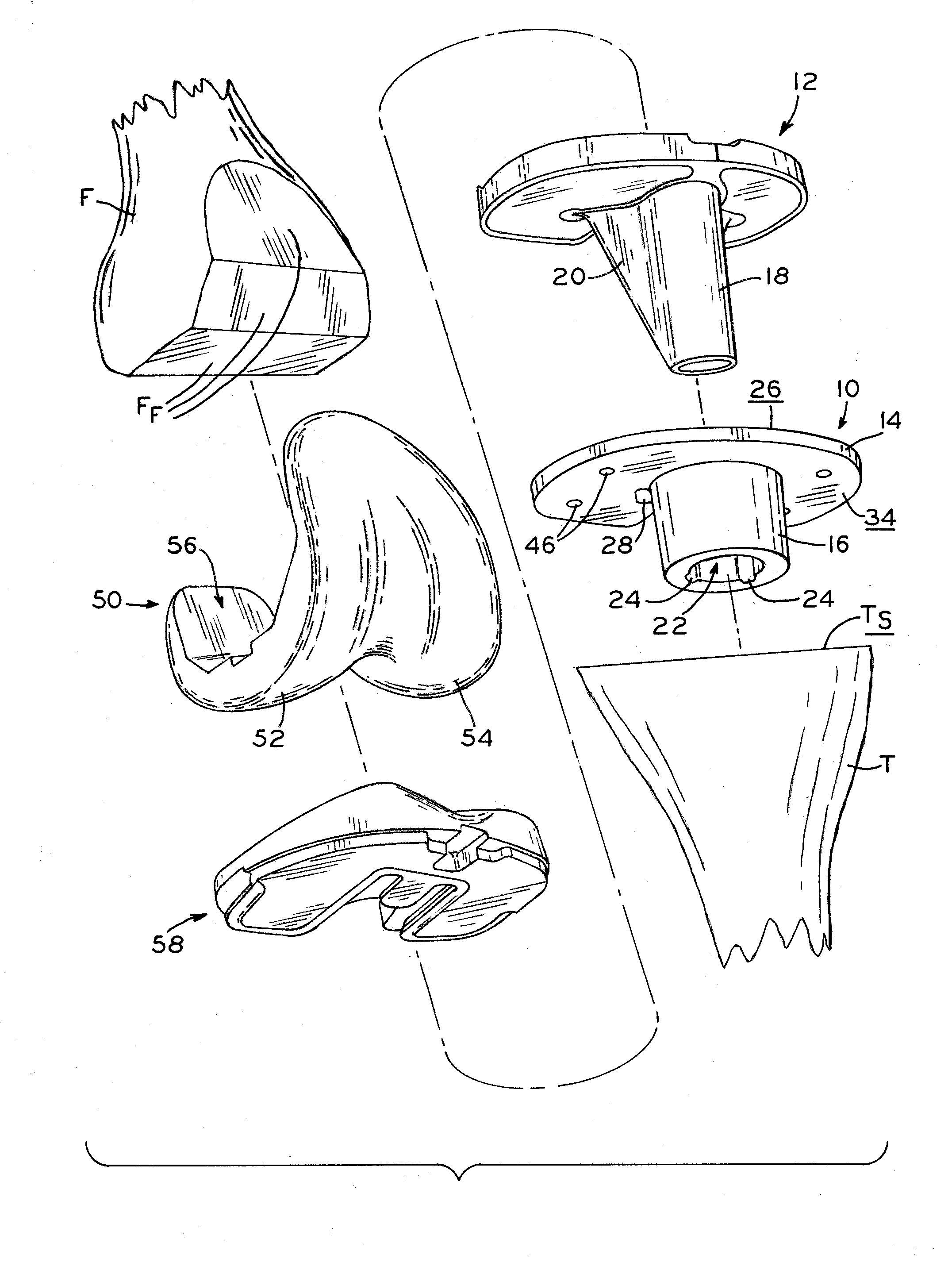 Stabilizing prosthesis support structure