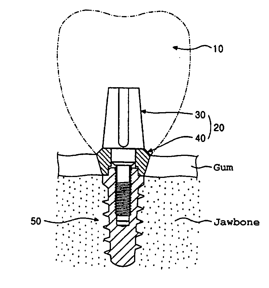 Abutment of dental implant and aesthetic surface treatment method of the same