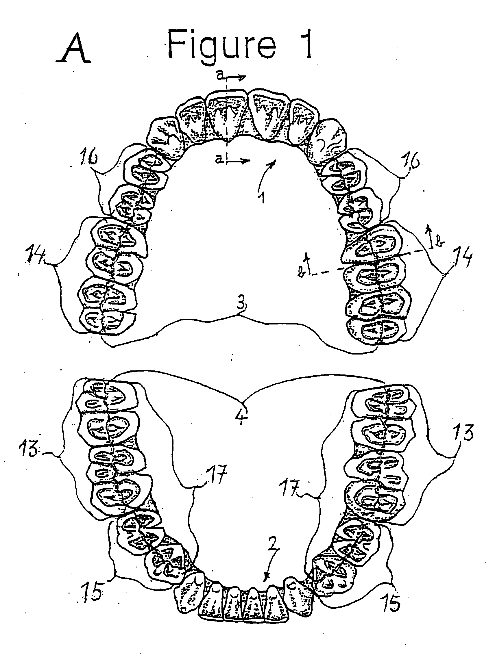 Combination set of artificial teeth units for setting-up dentures in balanced articulation