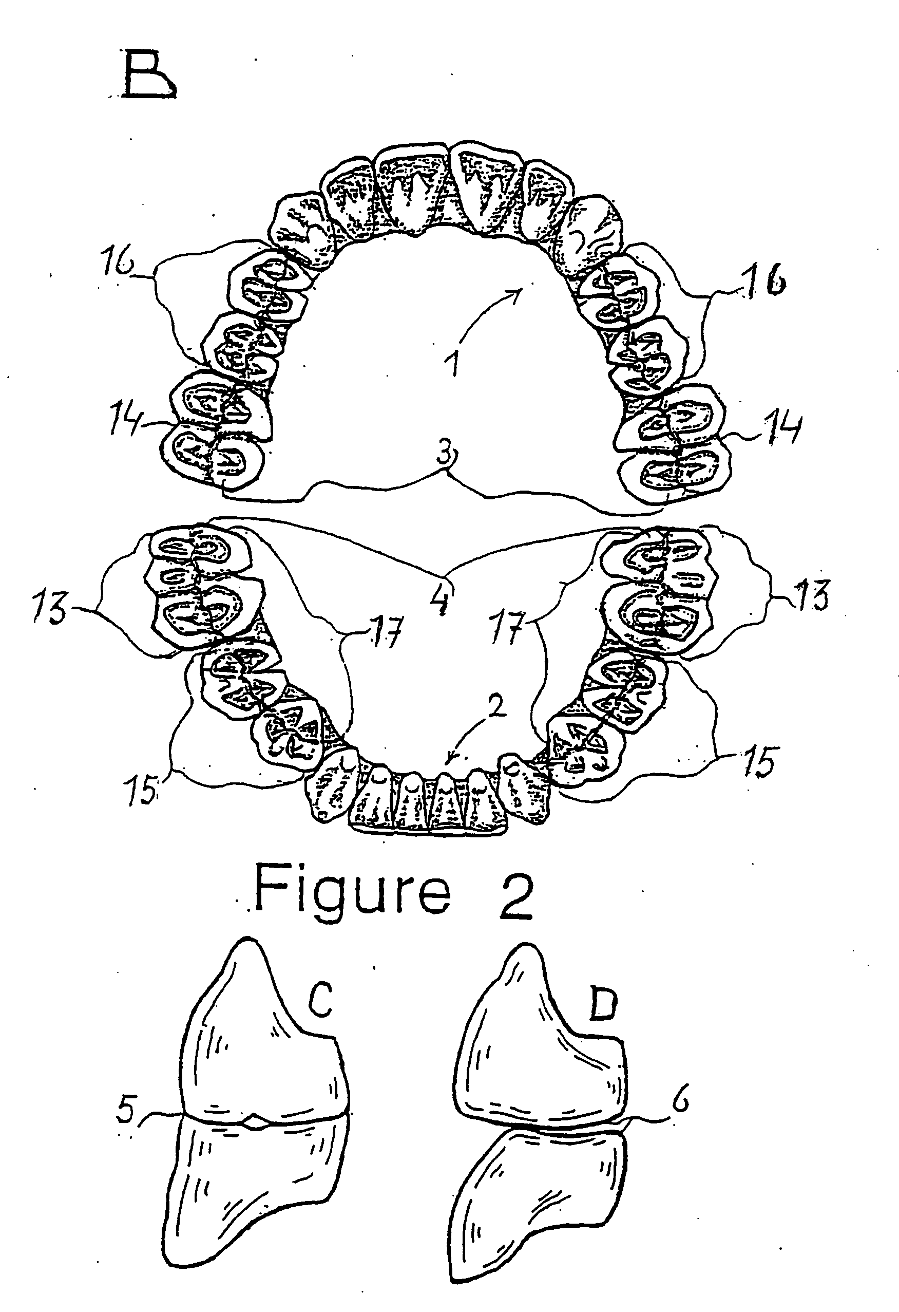 Combination set of artificial teeth units for setting-up dentures in balanced articulation