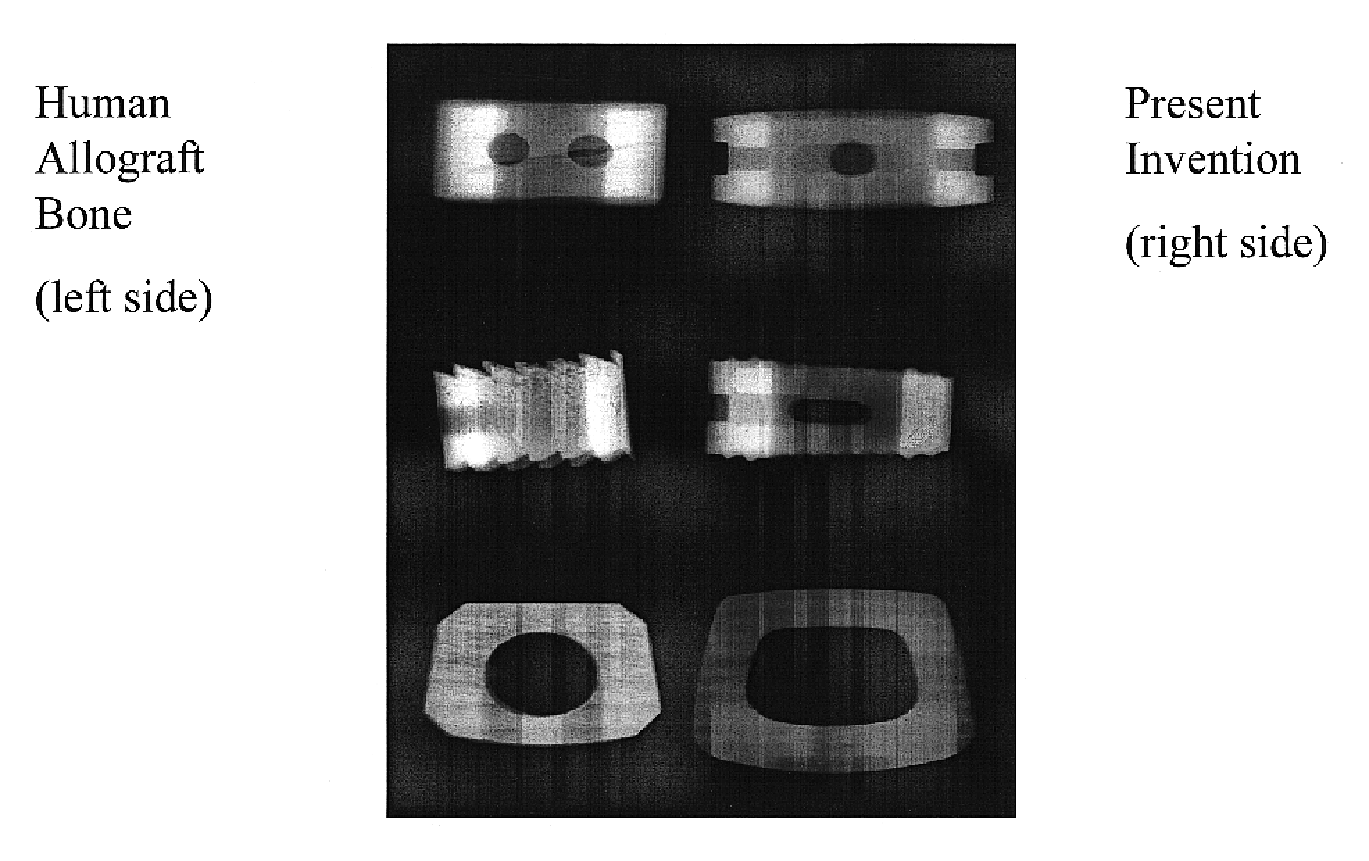 Bioactive spinal implant material and method of manufacture thereof