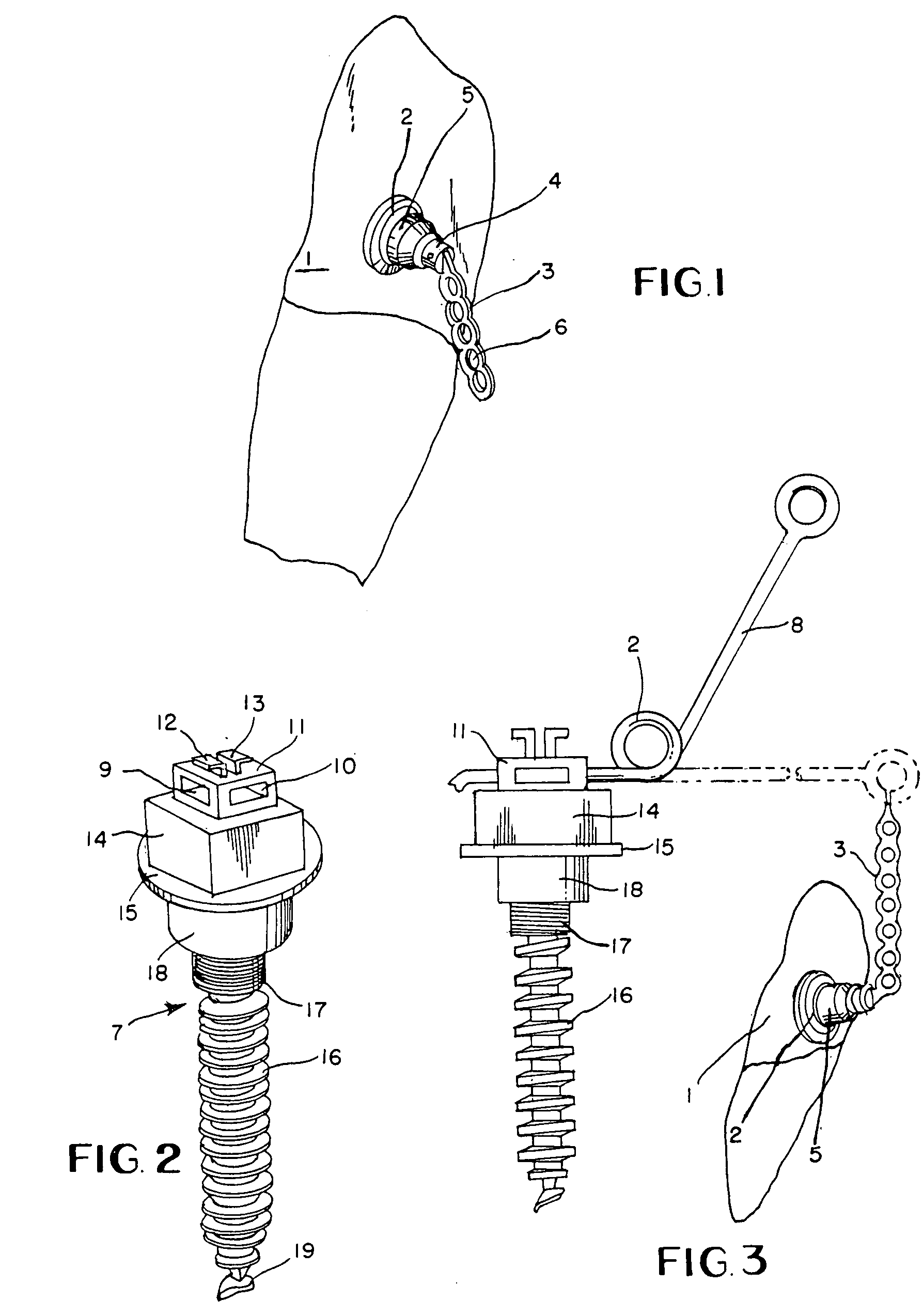 Impacted tooth appliance