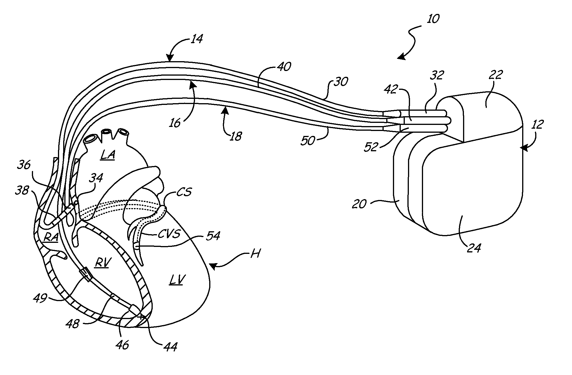 Implantable Medical Device with Electromechanical Delay Measurement for Lead Position and Ventricular