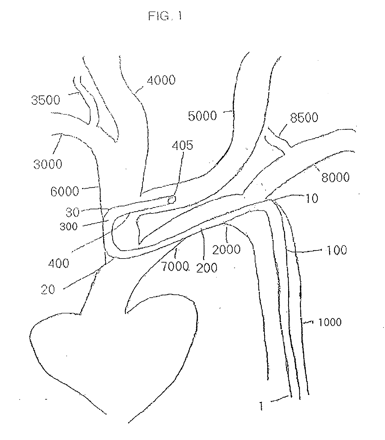 Arm access arch fulcrum support catheter