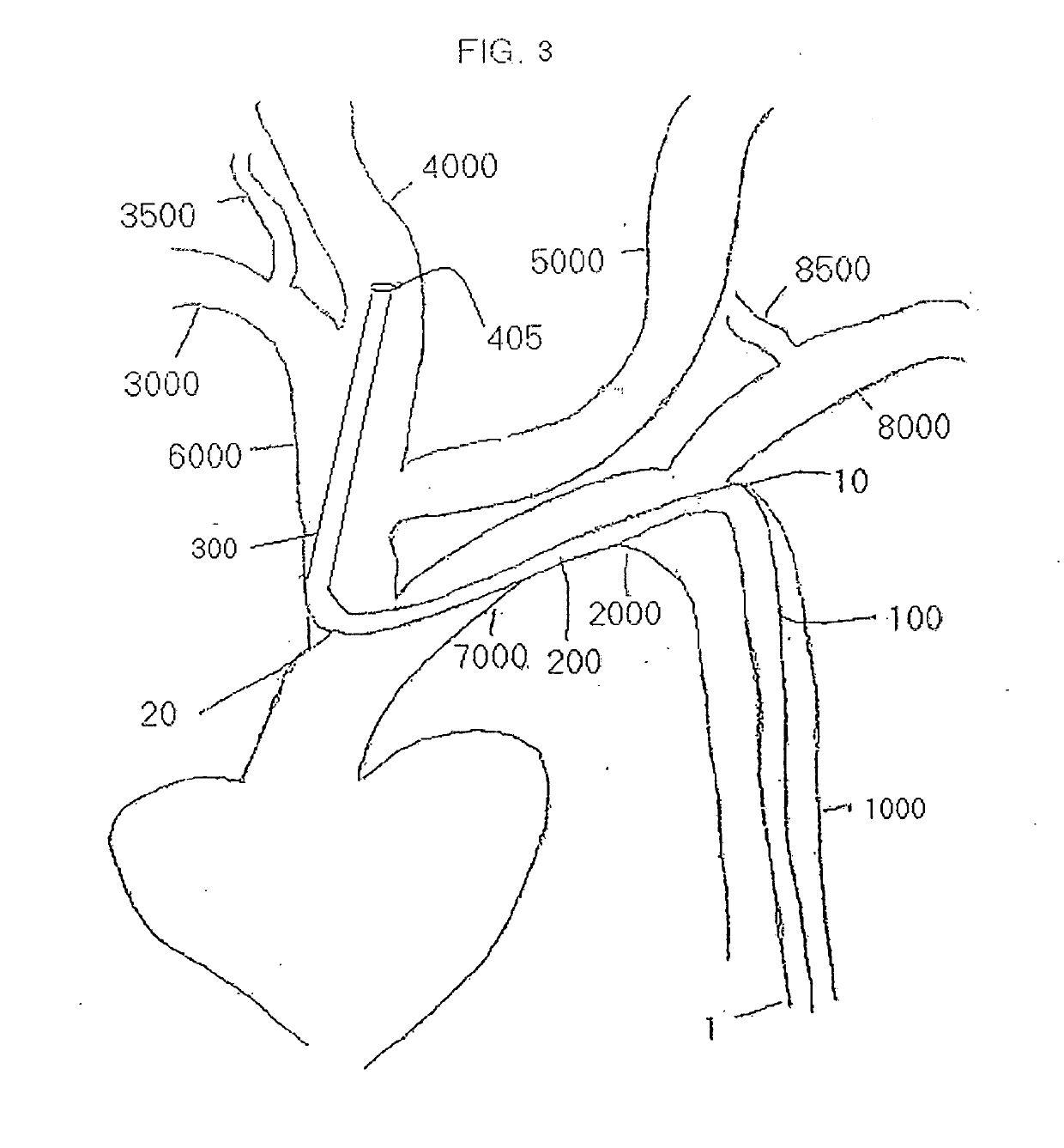 Arm access arch fulcrum support catheter