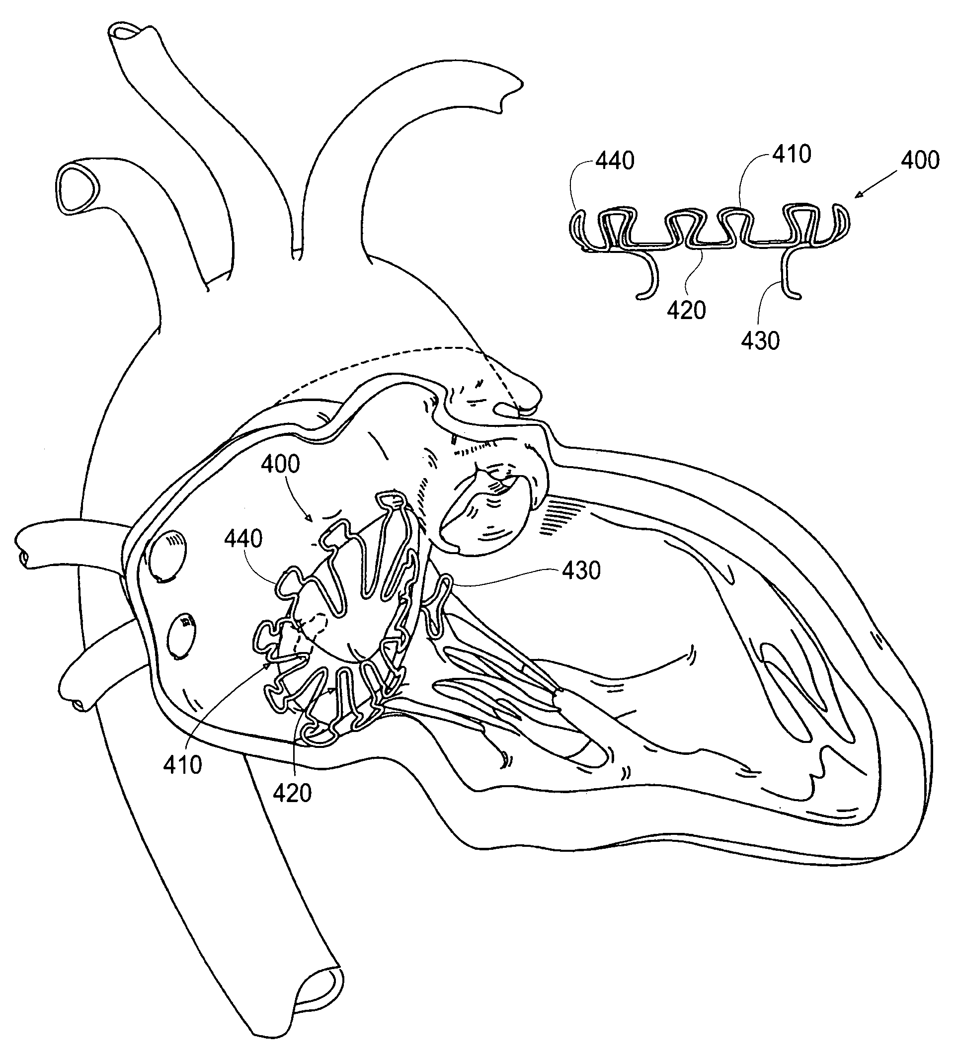 Devices, systems, and methods for retaining a native heart valve leaflet