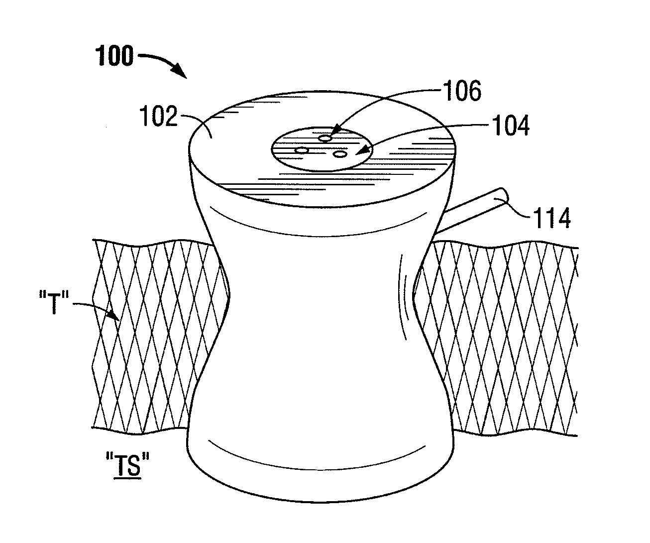 Single incision surgical portal apparatus including inner member