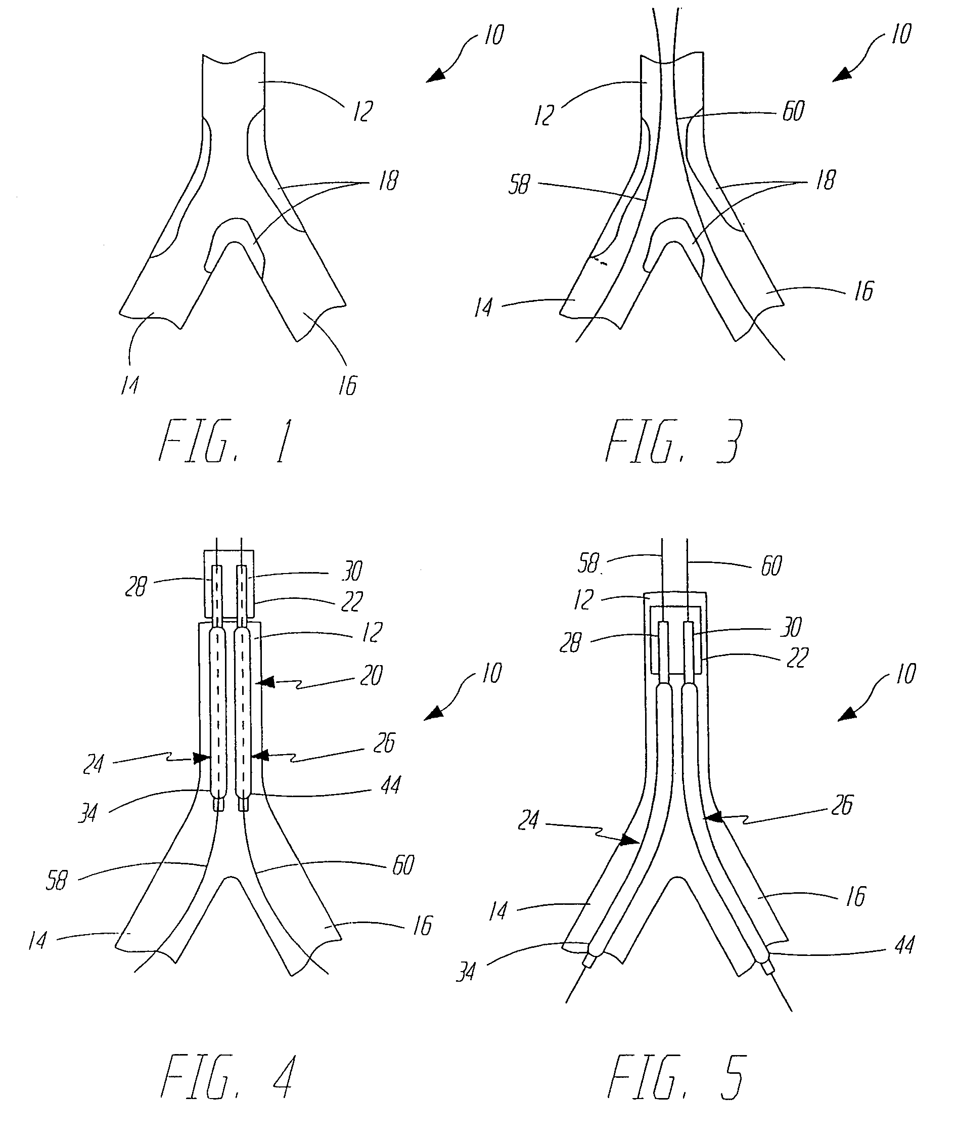 Dilation and stent delivery system for bifurcation lesions