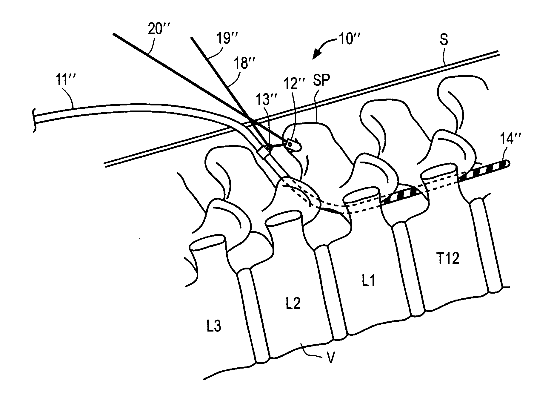 Apparatus and methods for anchoring electrode leads for use with implantable neuromuscular electrical stimulator