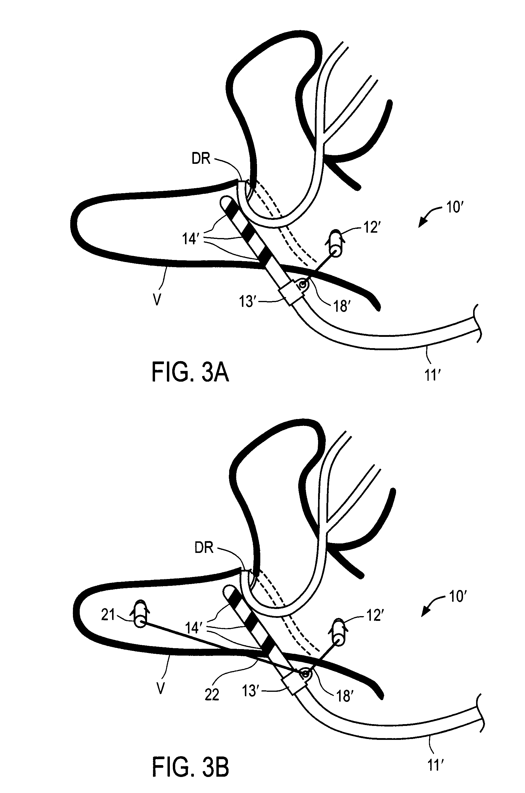 Apparatus and methods for anchoring electrode leads for use with implantable neuromuscular electrical stimulator