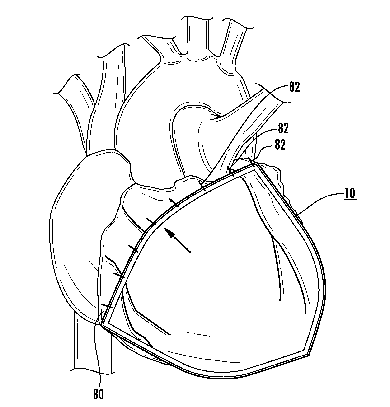 Bioactive implant for myocardial regeneration and ventricular chamber restoration