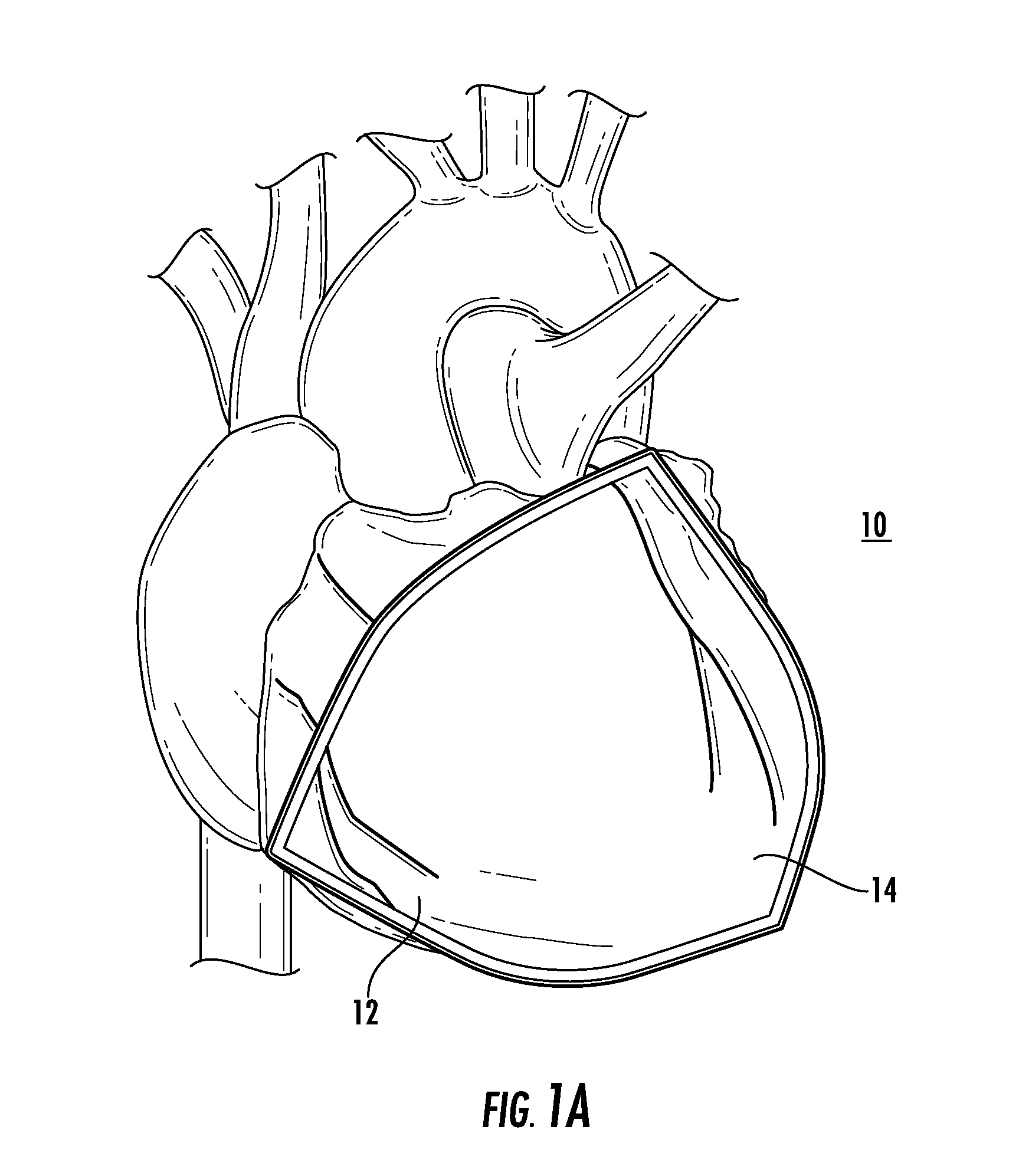 Bioactive implant for myocardial regeneration and ventricular chamber restoration
