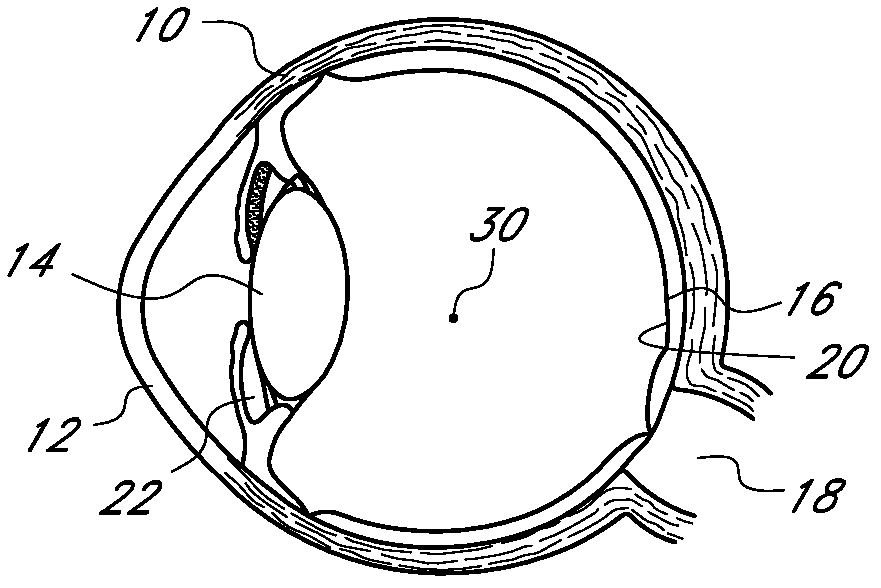 Corneal inlay with nutrient transport structures