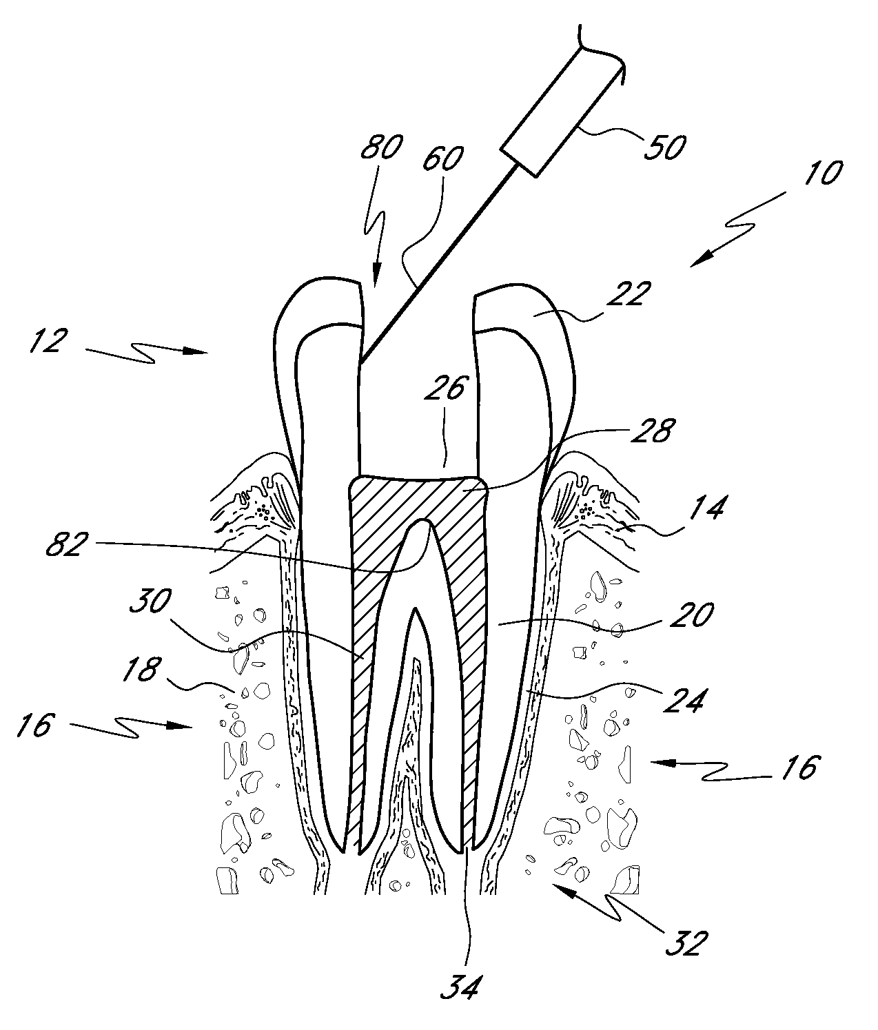 Apparatus and methods for treating root canals of teeth