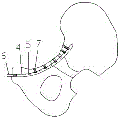 A minimally invasive intramedullary fixation device for pelvic fractures