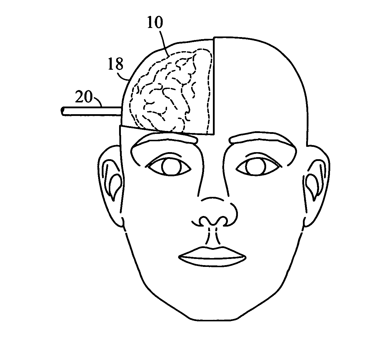 Cooled craniectomy