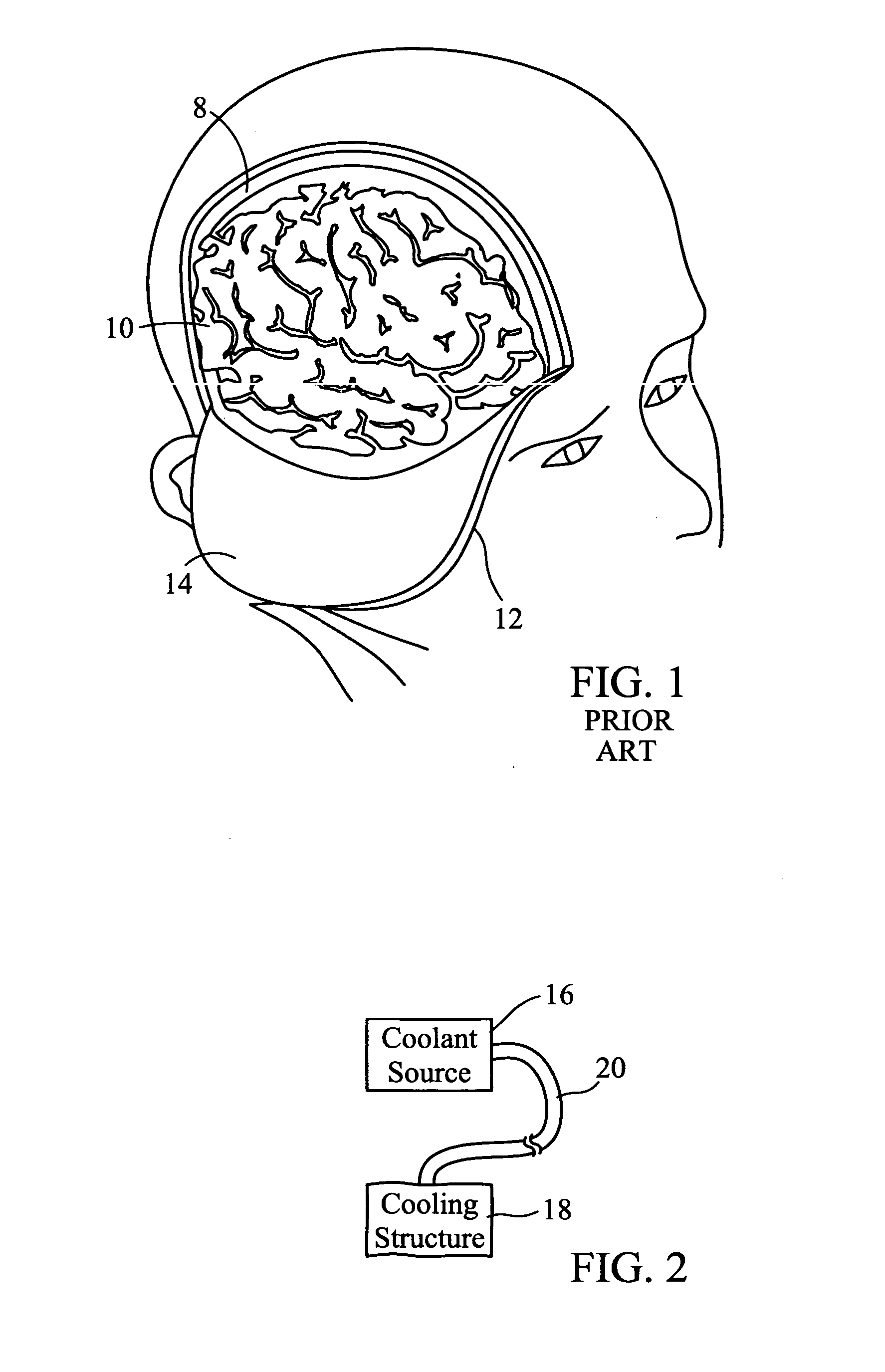 Cooled craniectomy