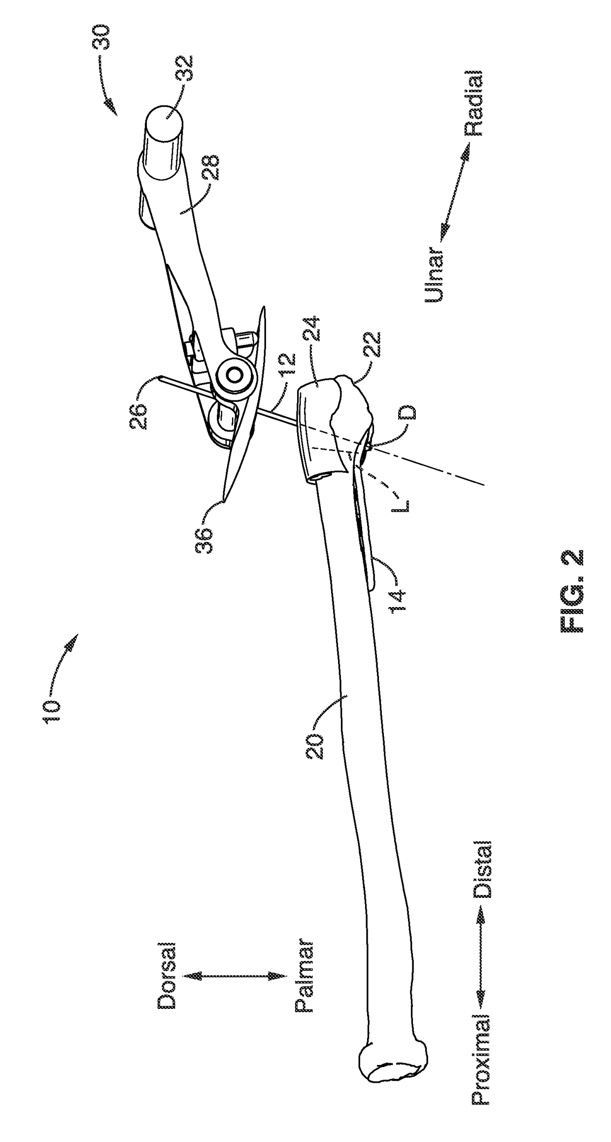 Method and apparatus for fracture reduction during internal fixation of distal radius fractures