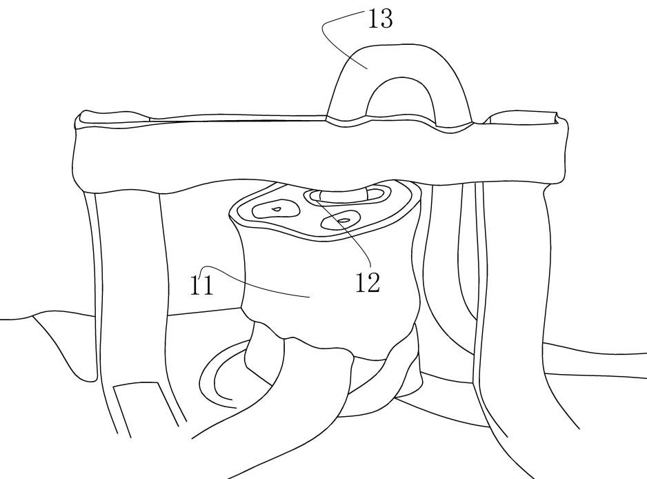 Bridging structure for fixing umbilical vein indwelling catheter of newborn