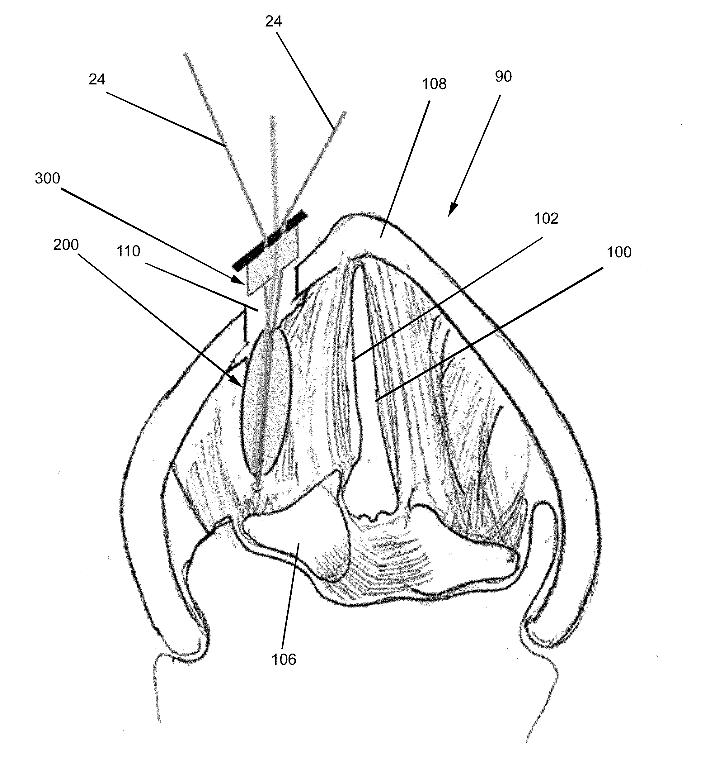 Devices and methods for anterior arytenoid adduction