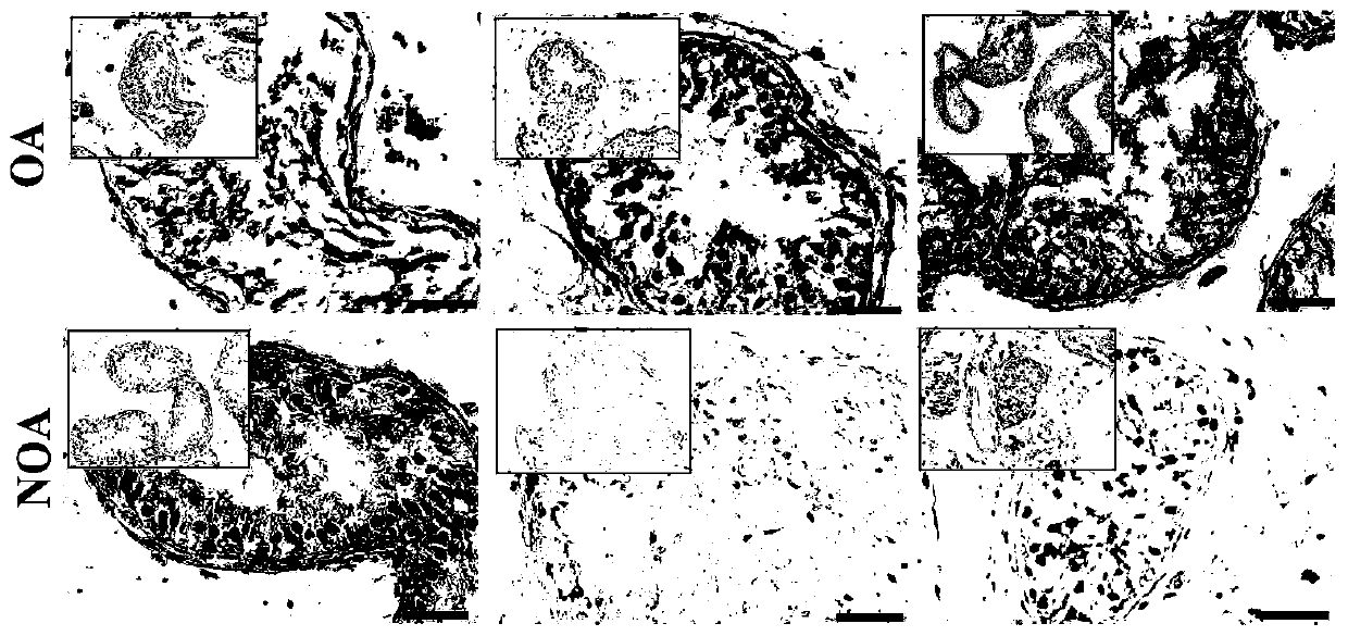 Application of gene SOX30 in treatment of non-obstructive azoospermia