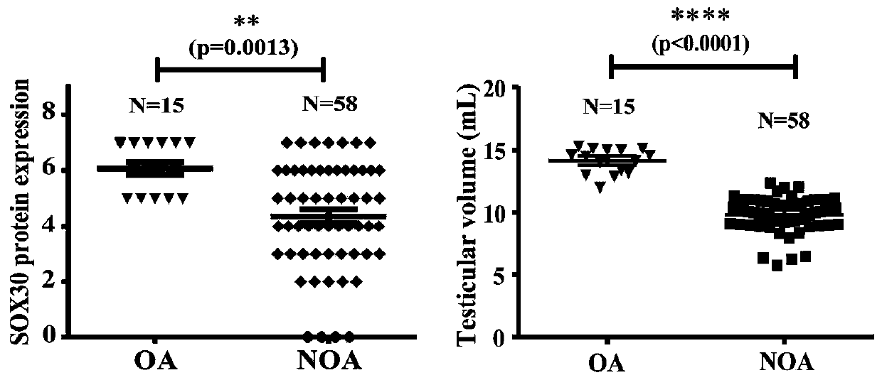 Application of gene SOX30 in treatment of non-obstructive azoospermia