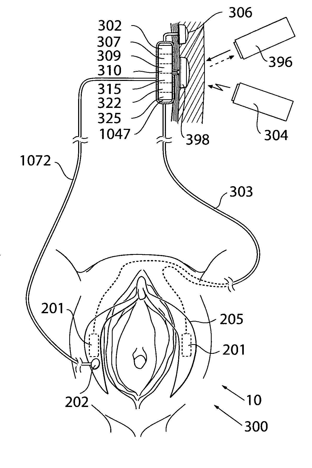 Apparatus, system and operation method for the treatment of female sexual dysfunction