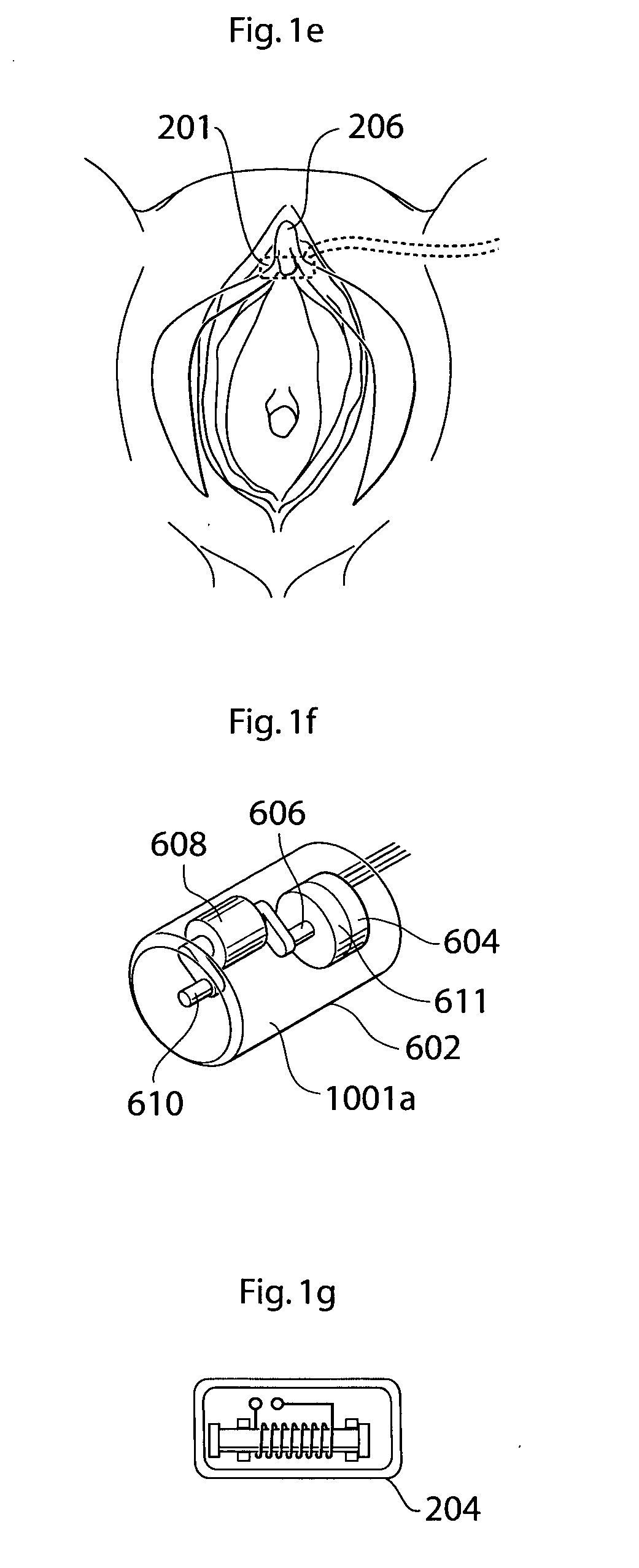 Apparatus, system and operation method for the treatment of female sexual dysfunction