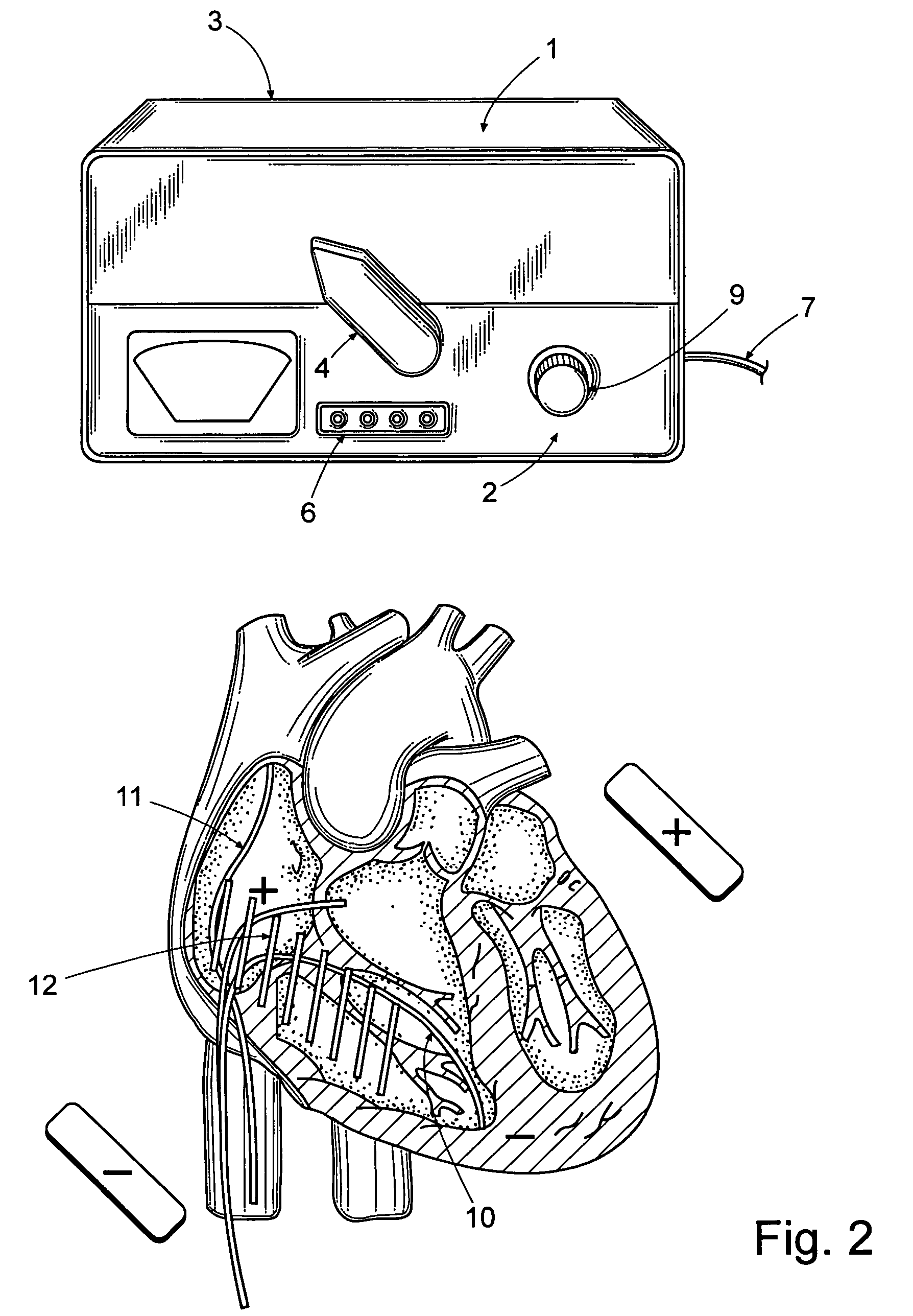 System for terminating heart arrhythmia using electrical shocks delivered through a set of internal and external electrodes configurable to a multitude of shock configurations by selecting the shock vector(s) on a control device that also provides "over shock" safety for patients.