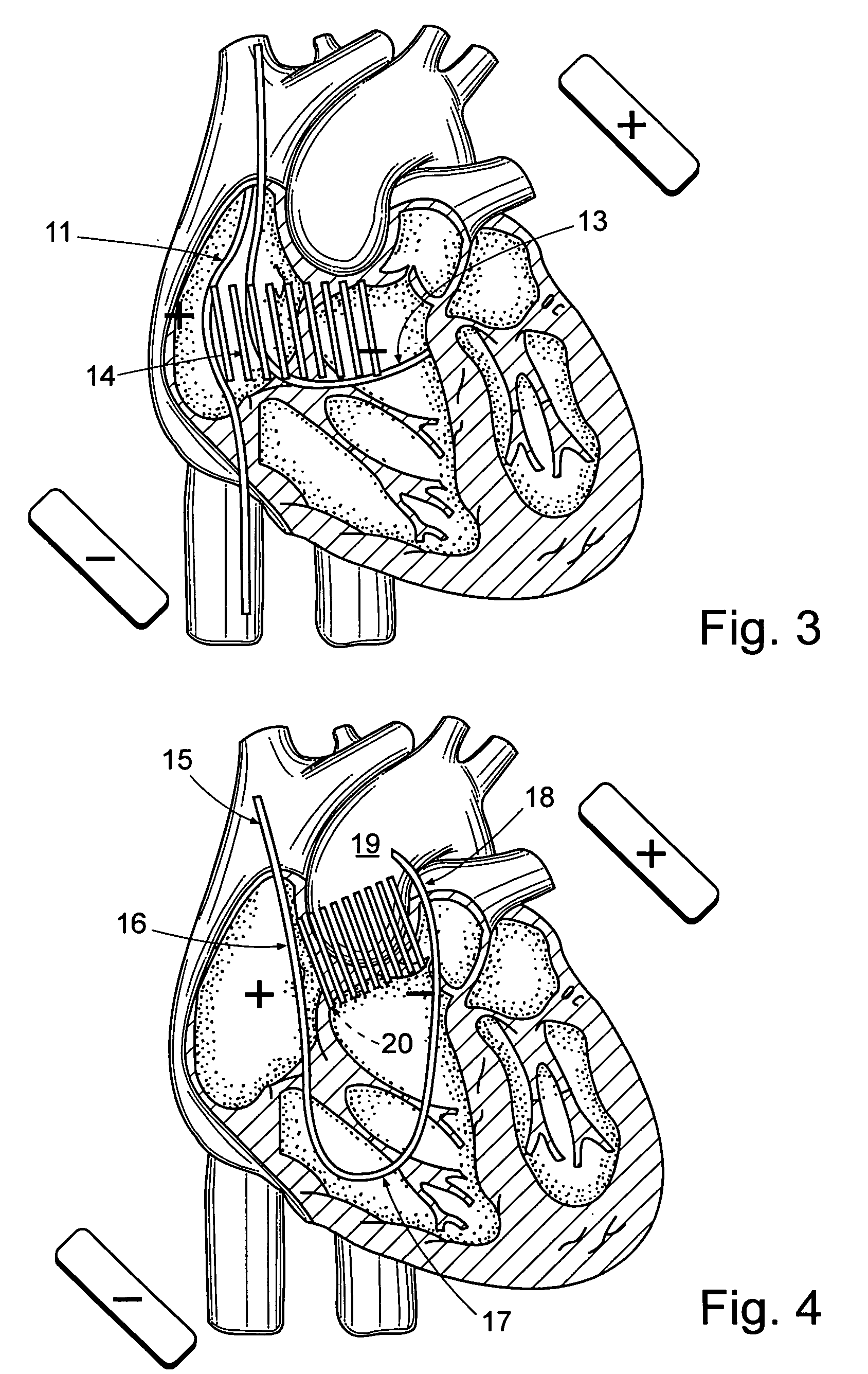 System for terminating heart arrhythmia using electrical shocks delivered through a set of internal and external electrodes configurable to a multitude of shock configurations by selecting the shock vector(s) on a control device that also provides "over shock" safety for patients.