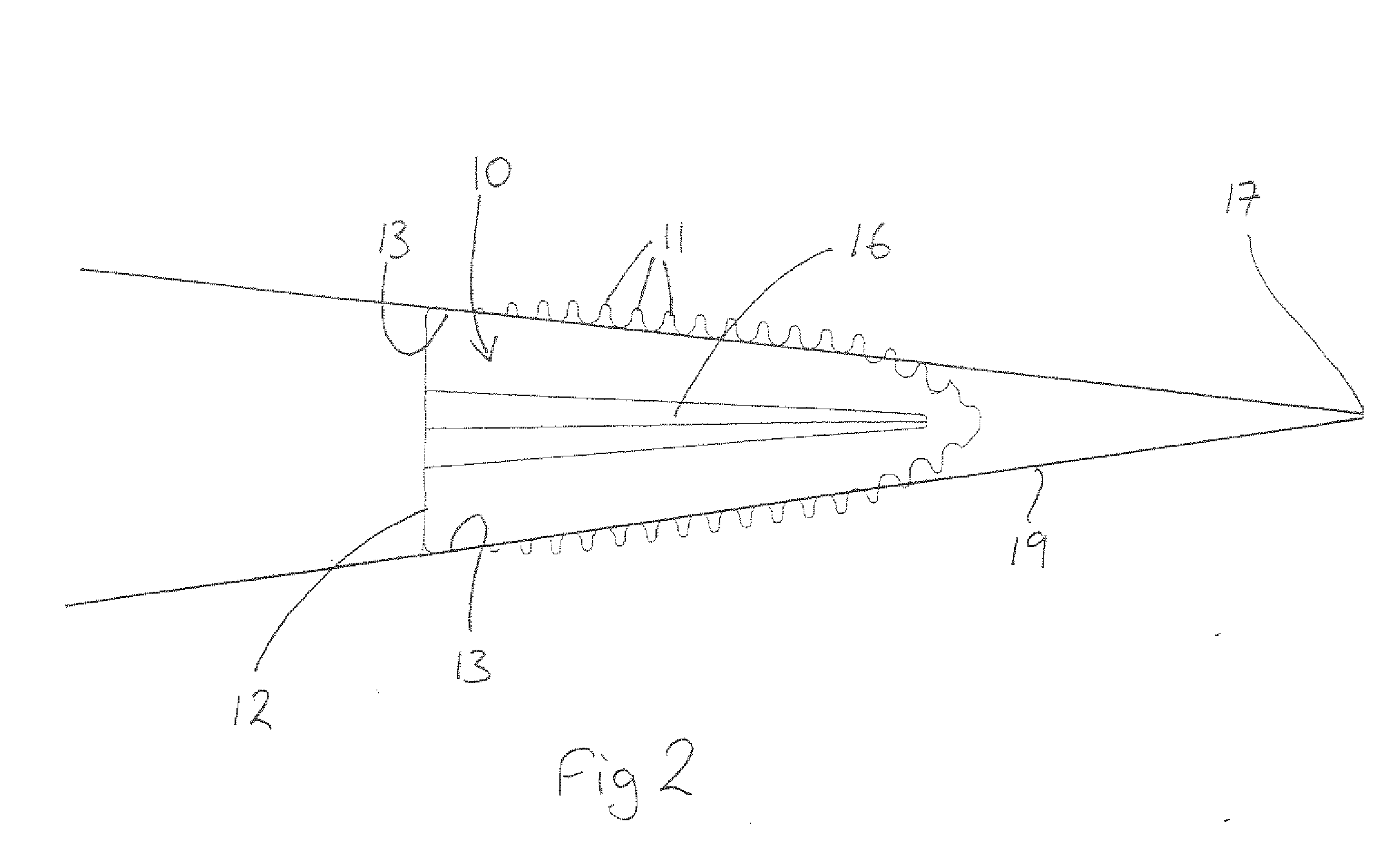 Tensegrity osteotomy system