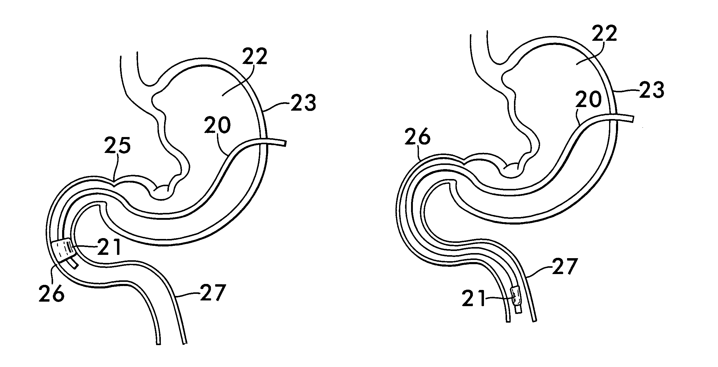 Gastrojejunal feeding tube