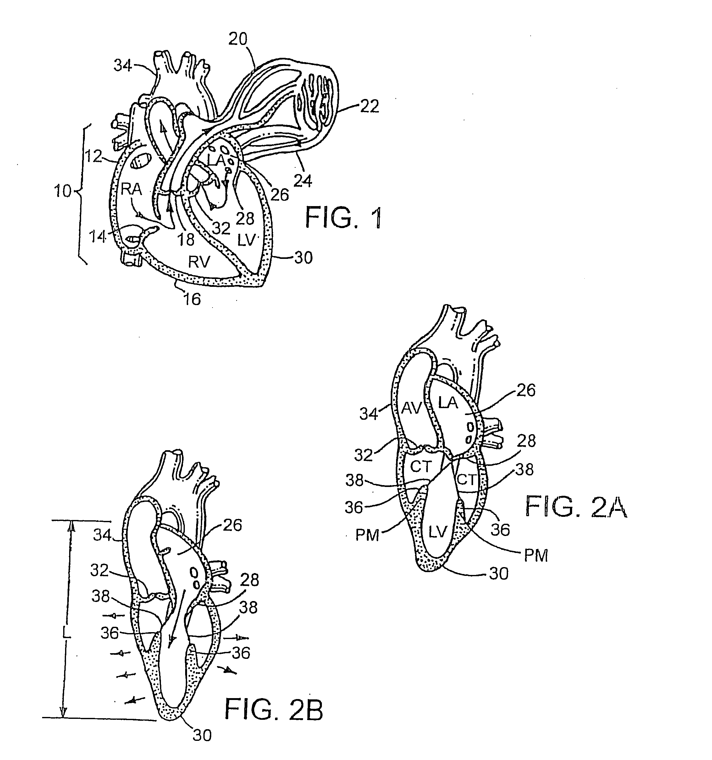 Device to permit offpump beating heart coronary bypass surgery