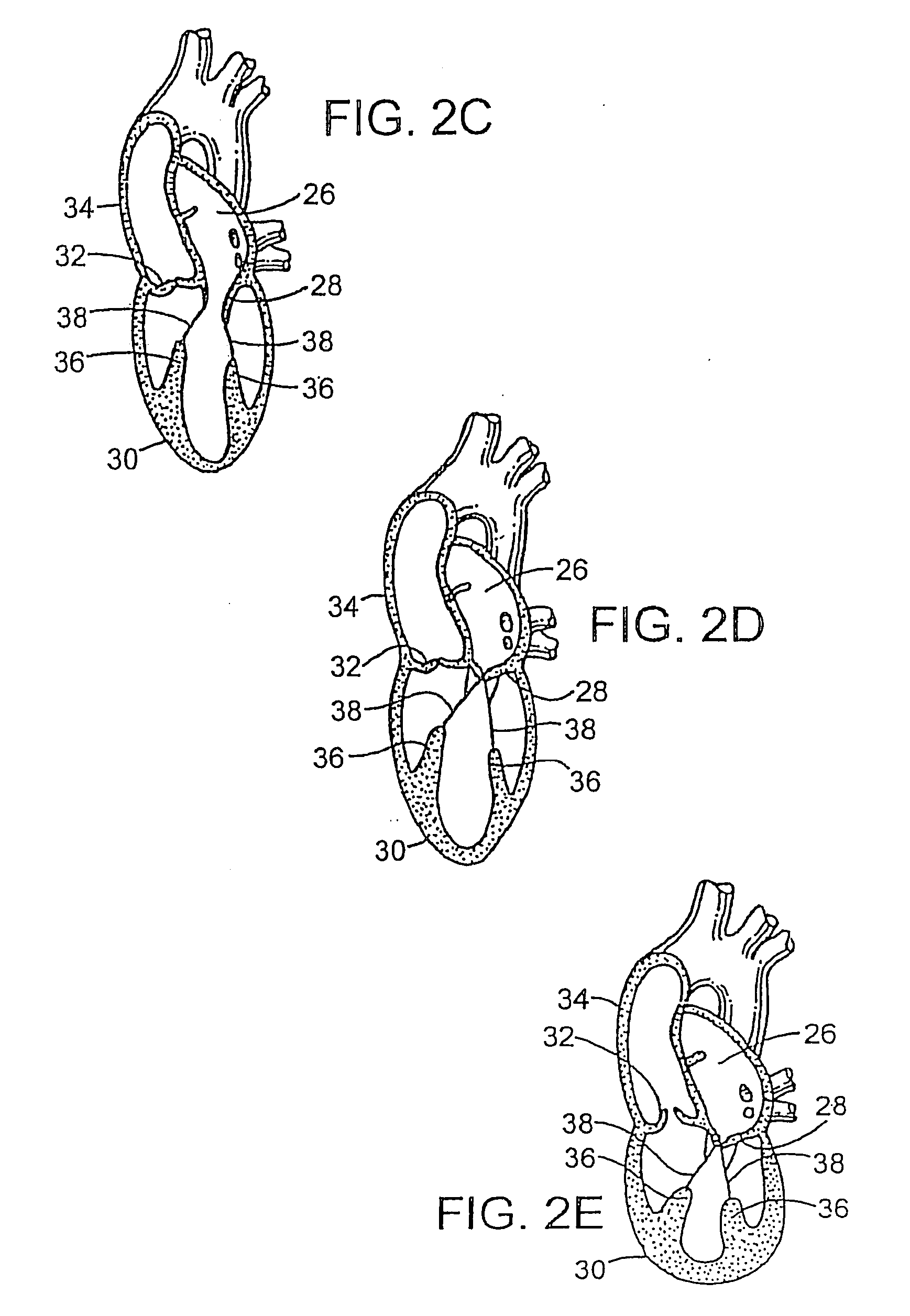 Device to permit offpump beating heart coronary bypass surgery