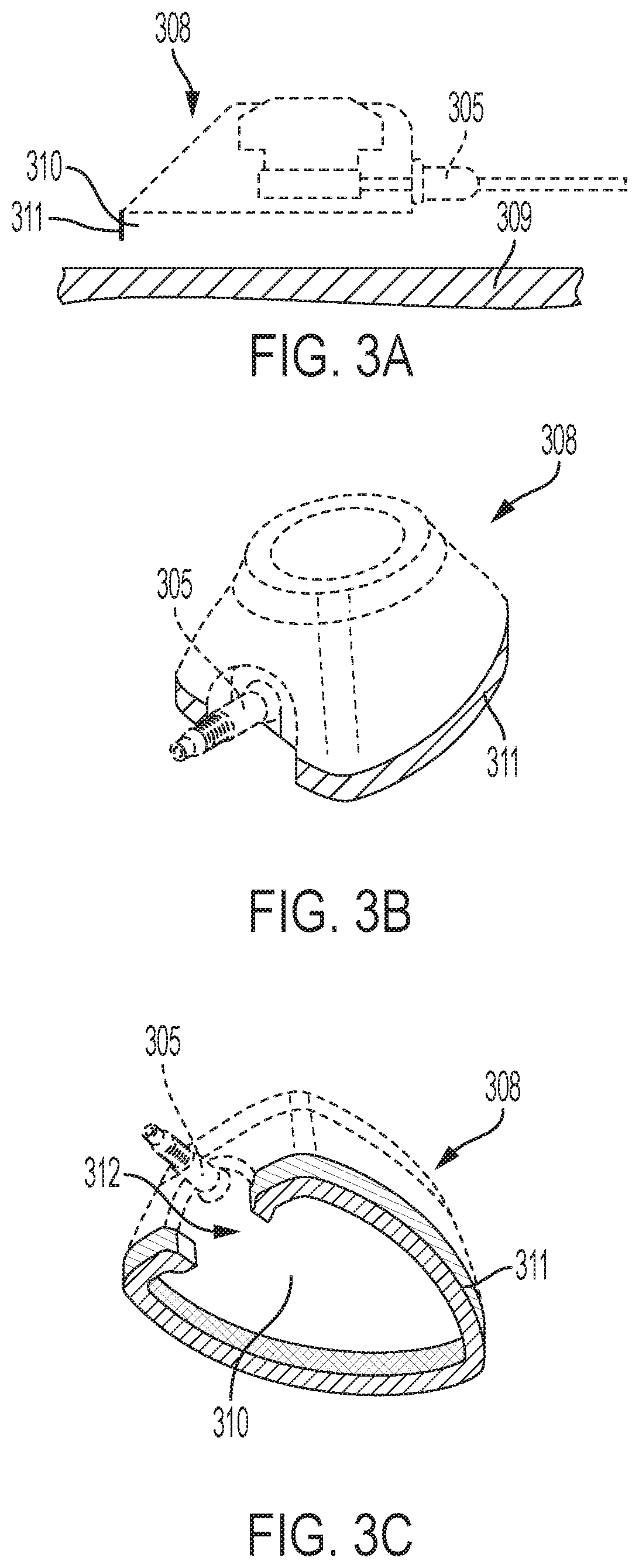 Access port system with self-adjusting catheter length