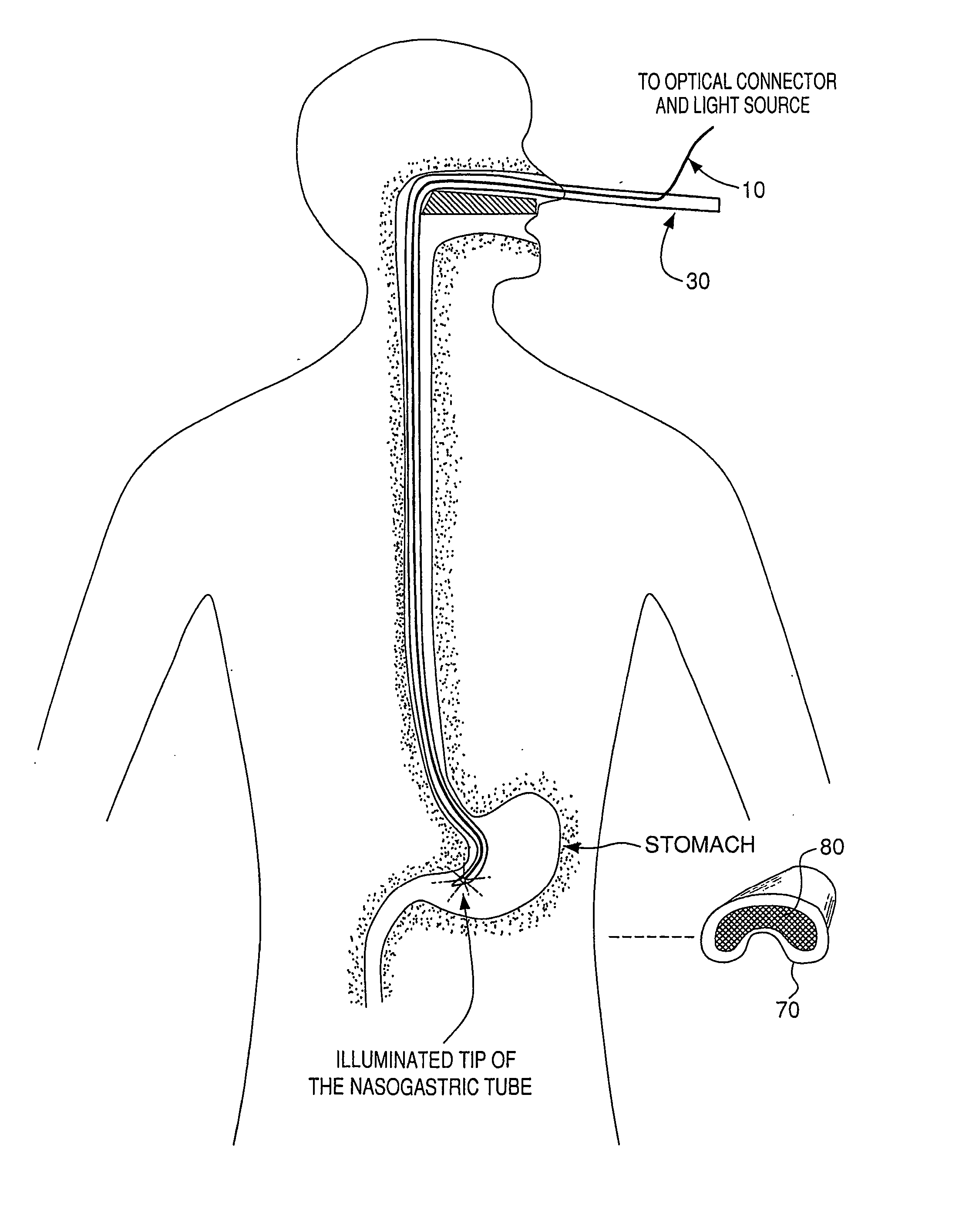 Optical guidance system for invasive catheter placement