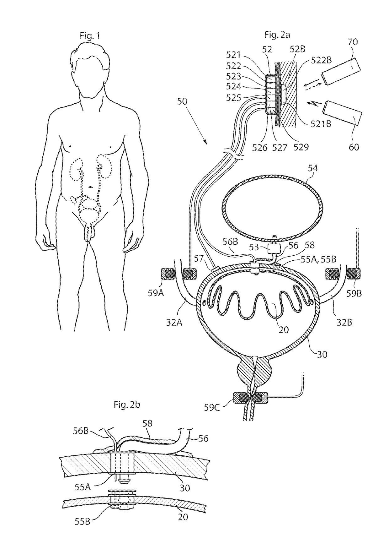 Implantable device for internal urinary control