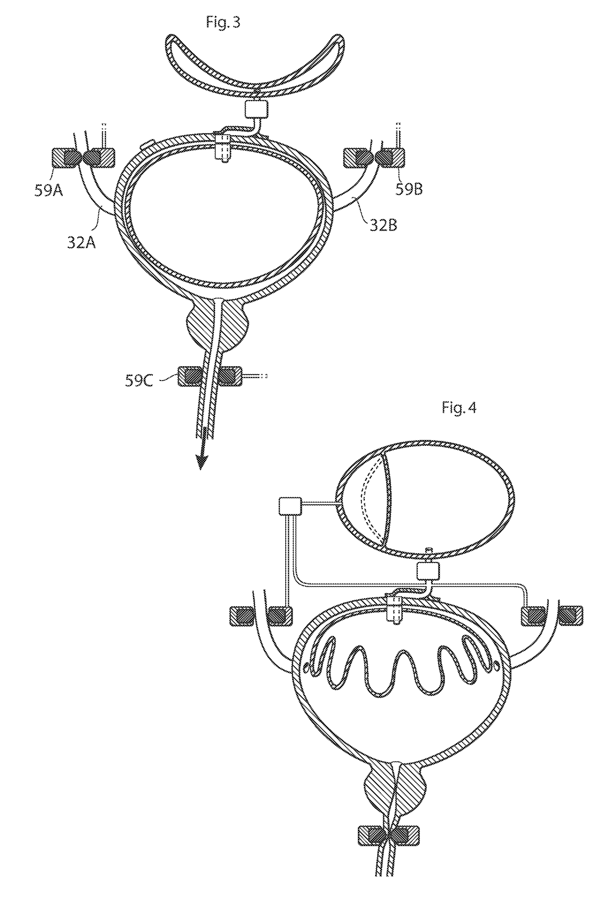 Implantable device for internal urinary control