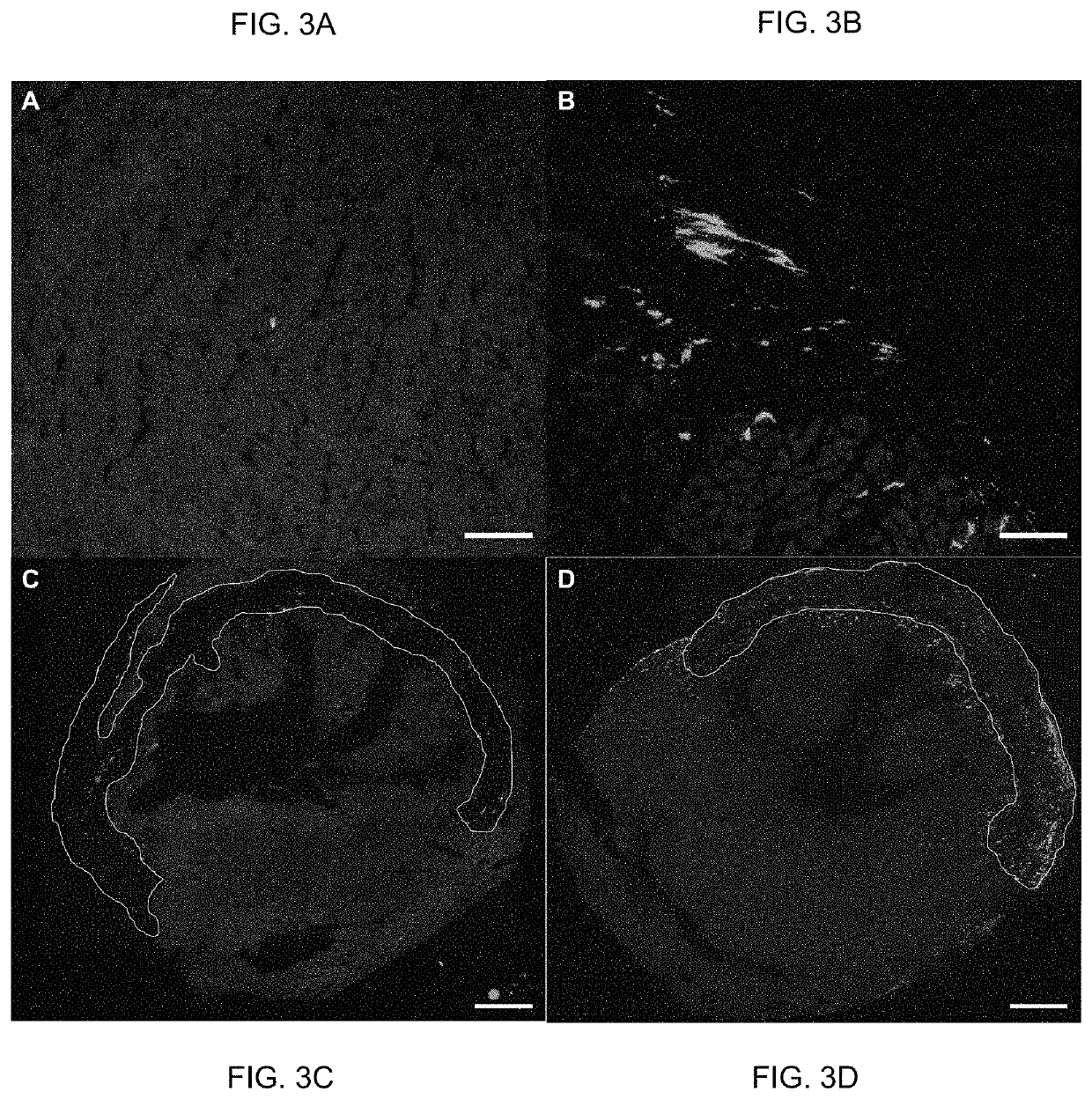 Compositions and methods for adeno-associated virus mediated gene expression in myofibroblast-like cells