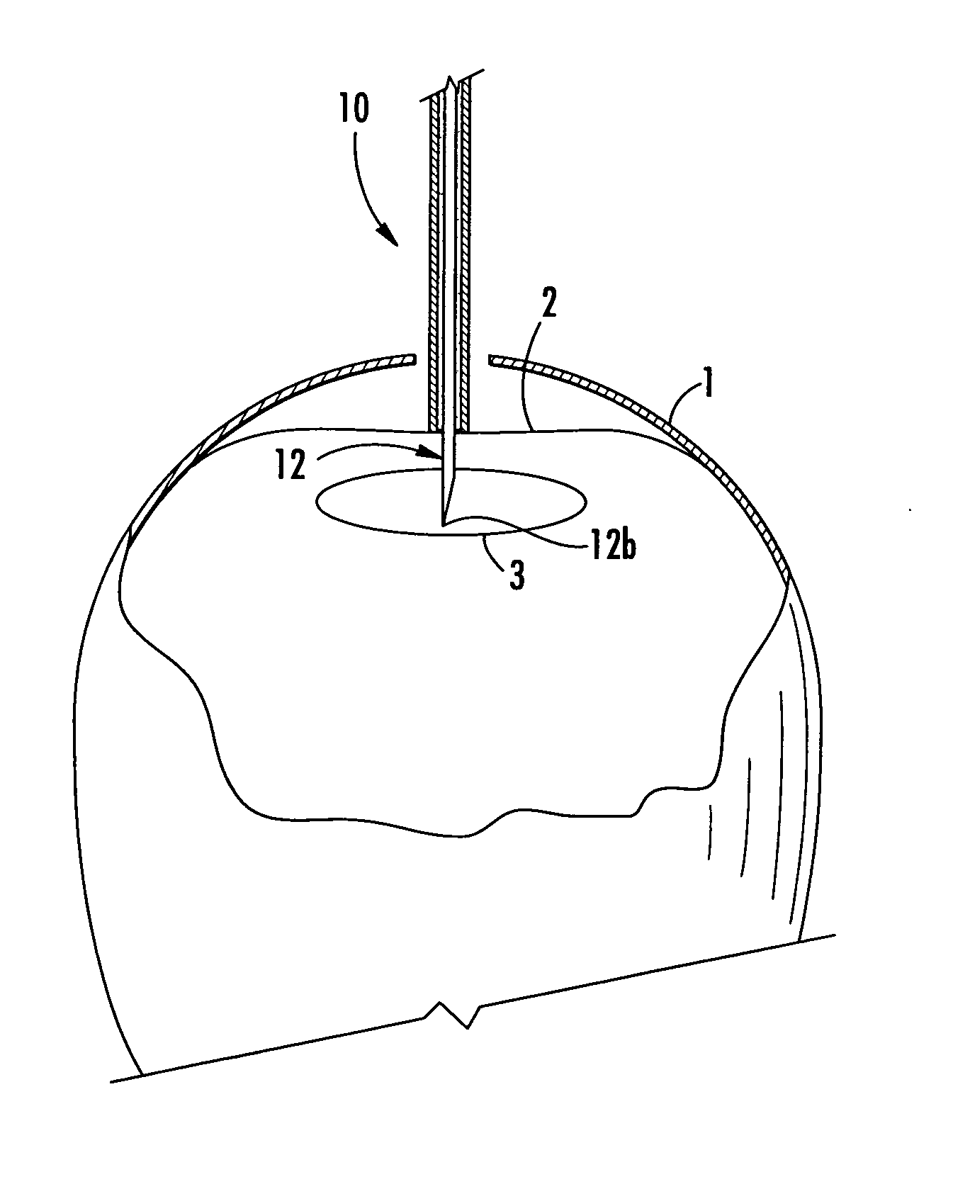 Methods and apparatus for injecting and sampling material through avian egg membranes