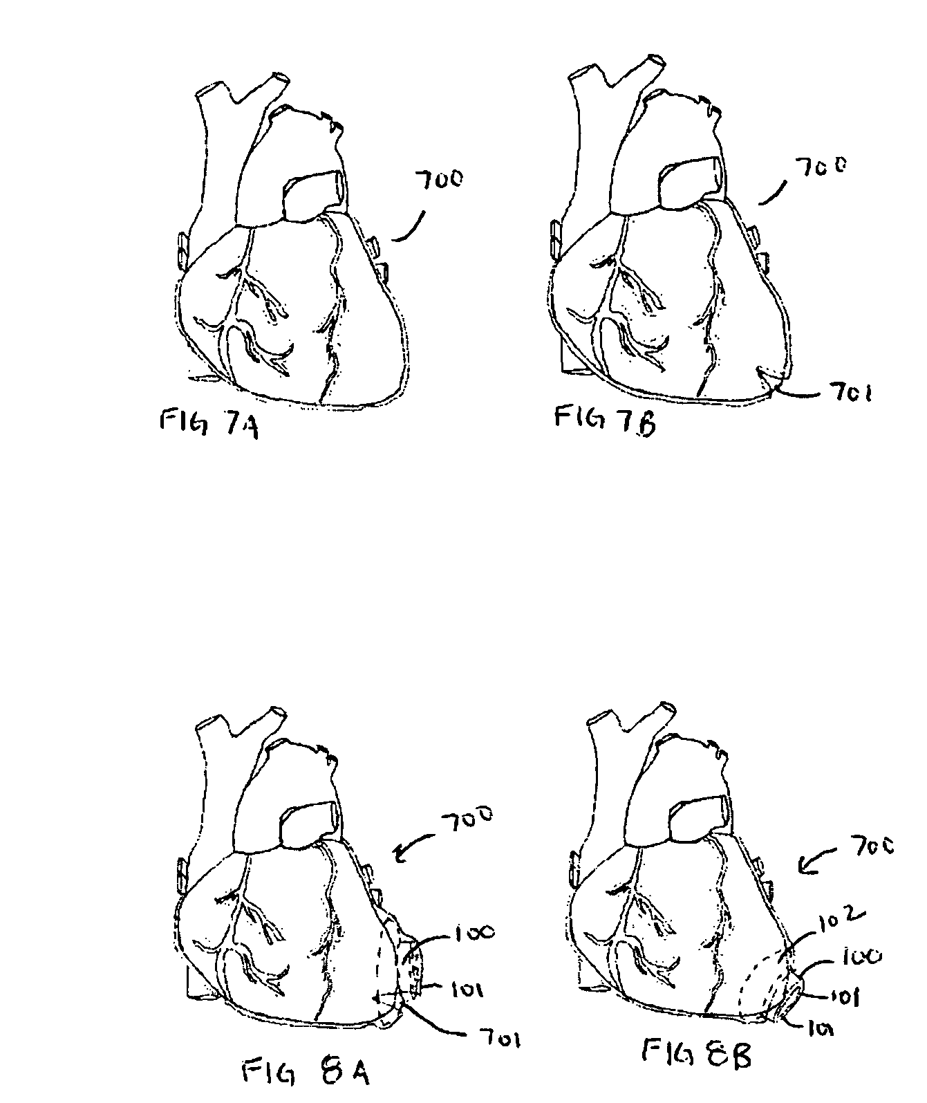 Apparatus and method for minimally invasive implantation of heart assist device