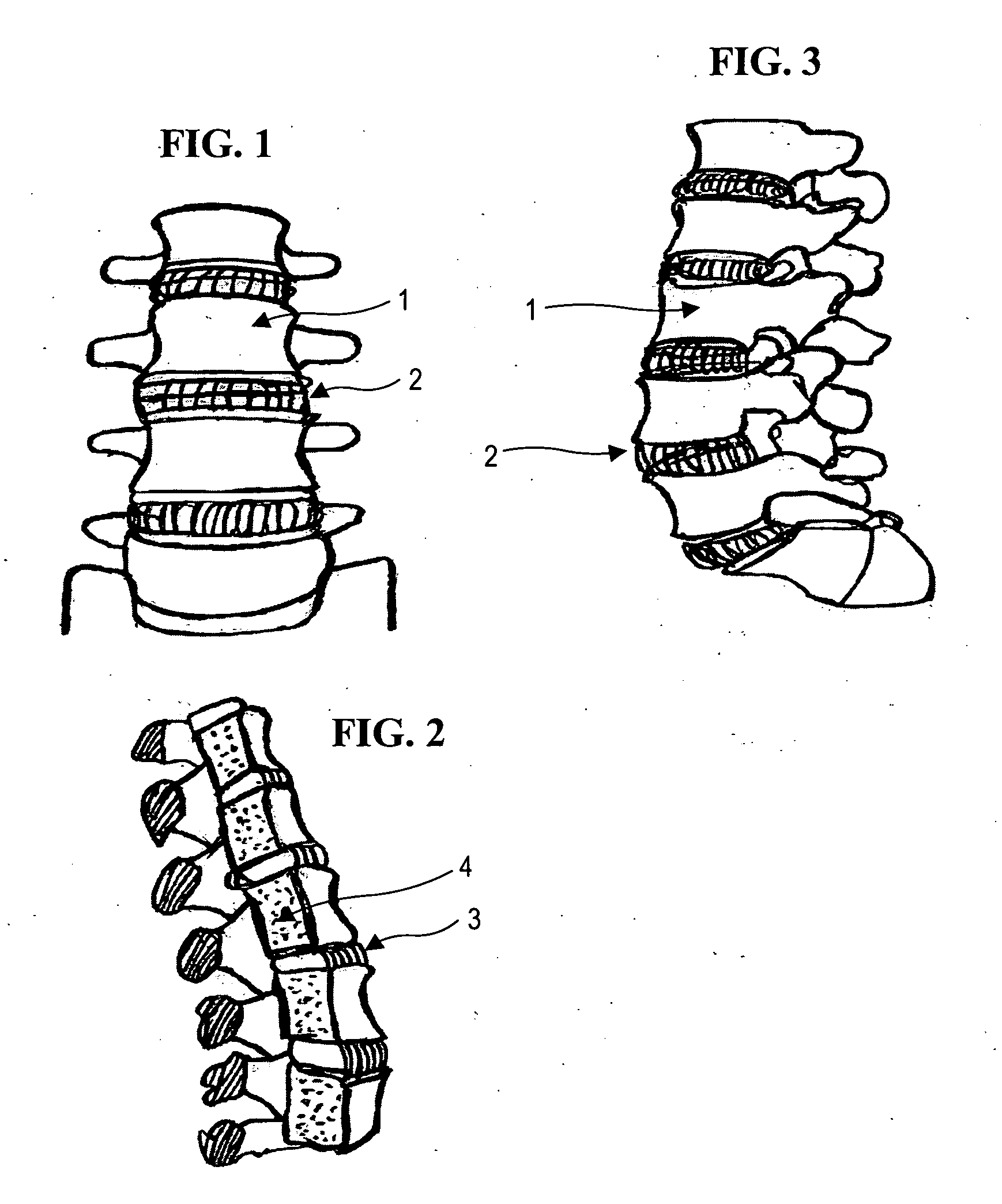 Apparatus and method for anterior intervertebral spinal fixation and fusion