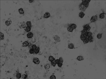 In-situ hybridization assay kit for mRNA level of premalignant pancreatic cancer ATDC (telangiectasia group D associated protein) gene as well as assay method and application