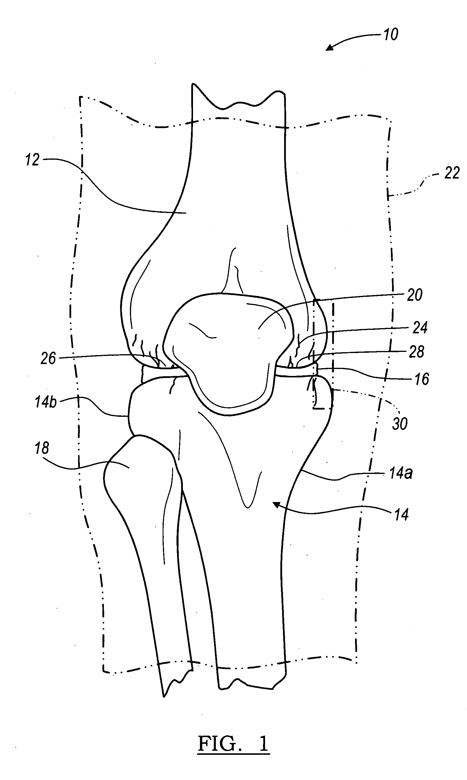 Instrumentation for knee resection