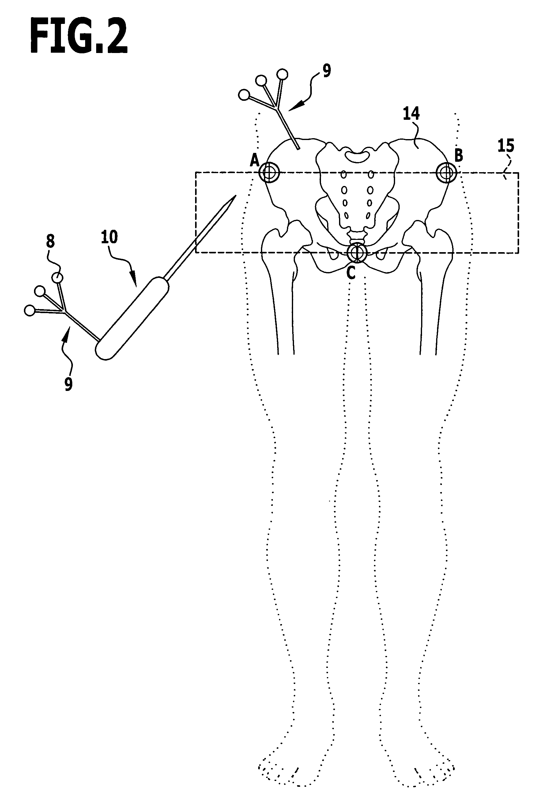 Method and apparatus for determining the angular position of an acetabulum in a pelvic bone